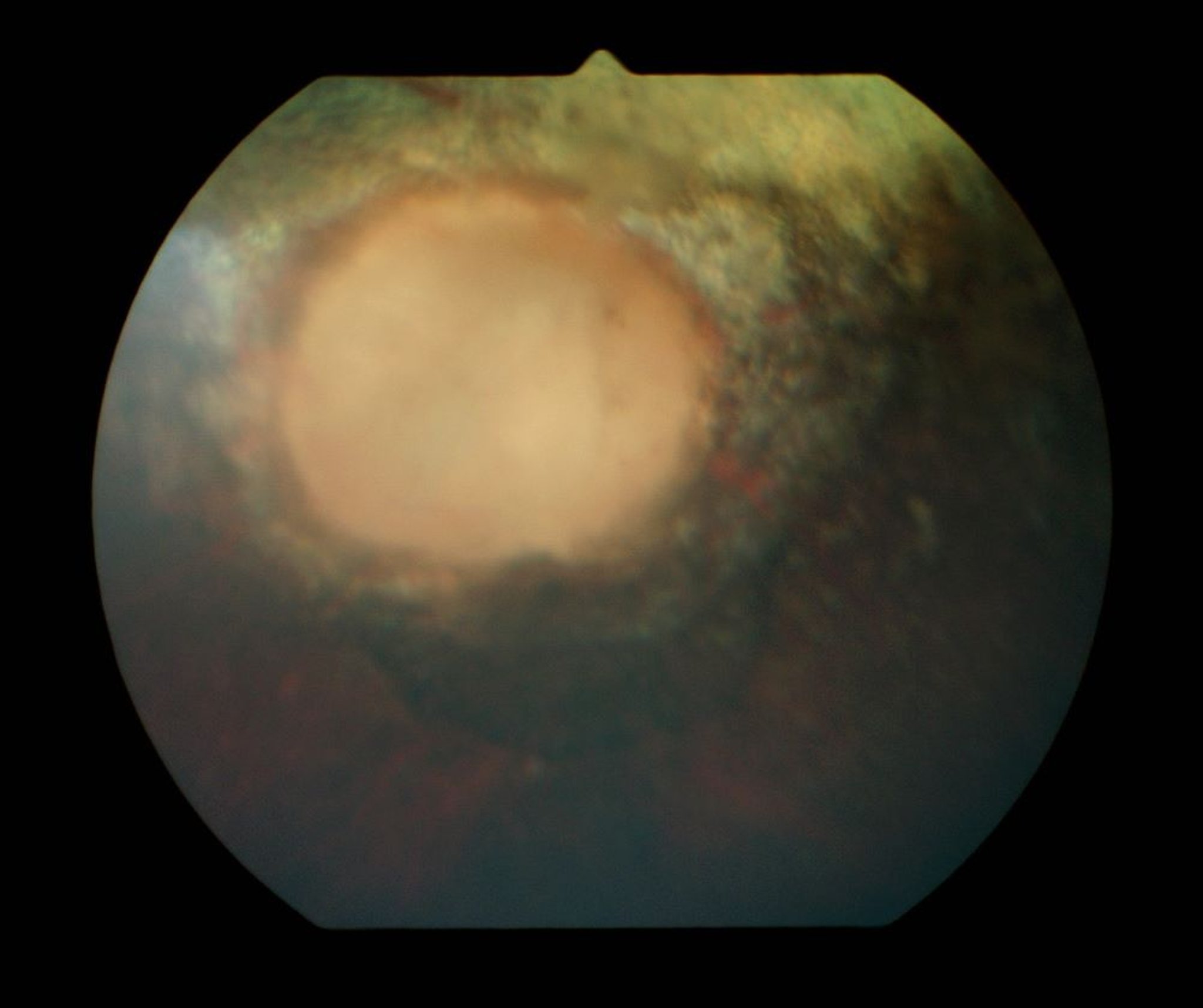 Image:Optic nerve atrophy and peripapillary retinal degeneration, horse ...