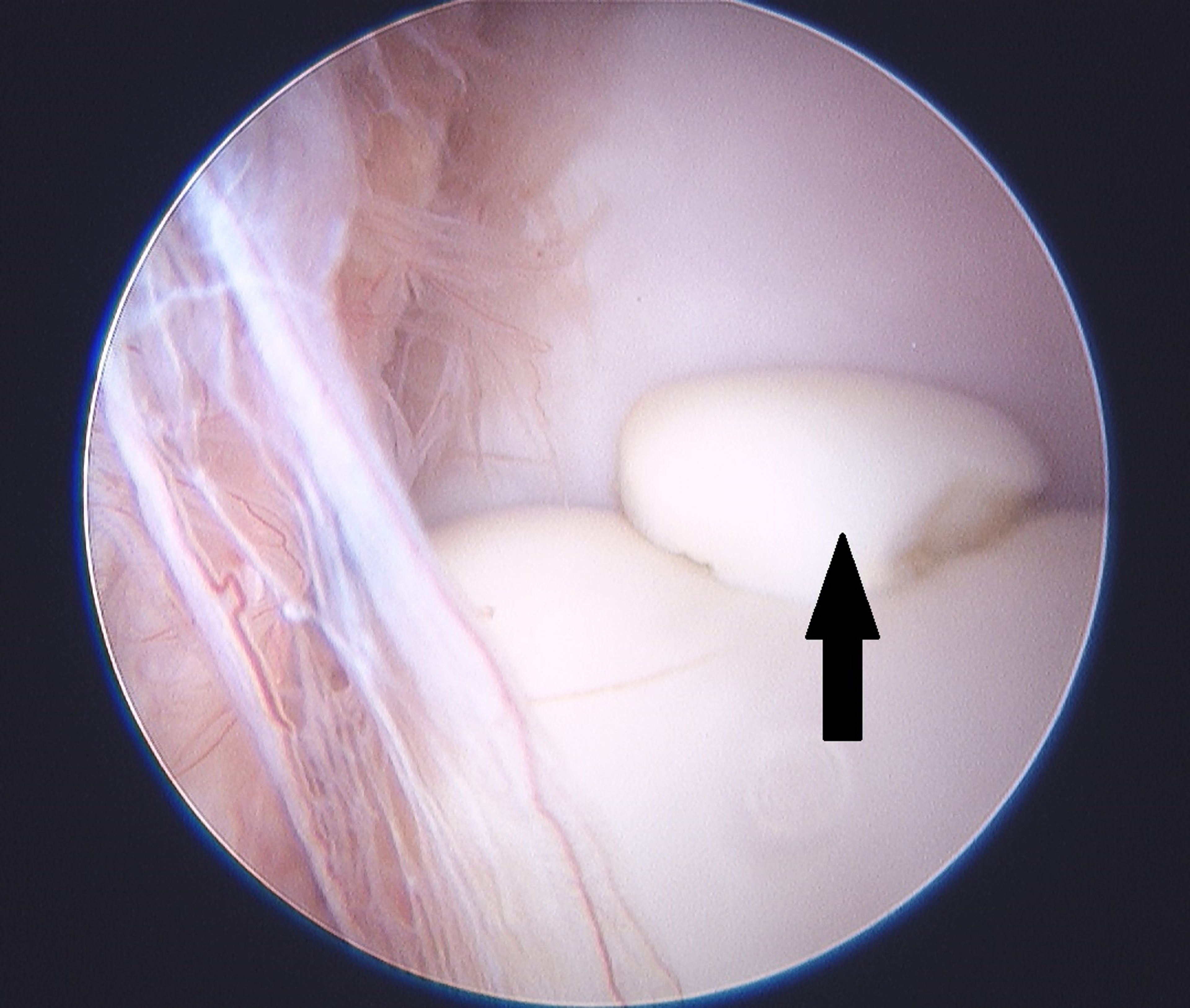 Osteocondritis disecante, articulación tarsocrural, caballo, vista artroscópica