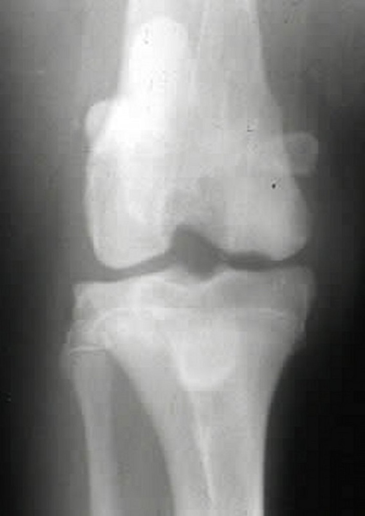 Osteochondrosis, stifle joint, radiograph, dog