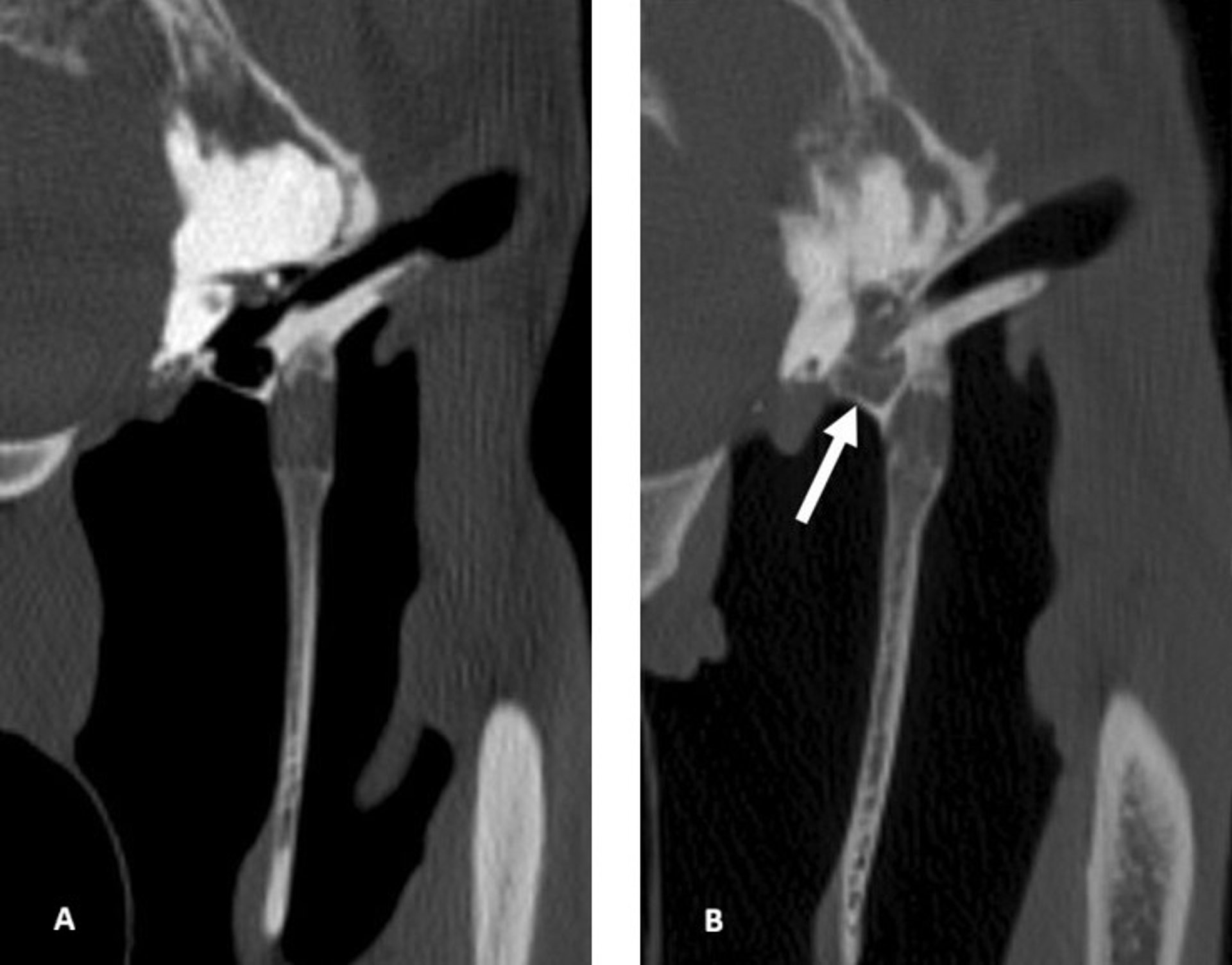 Otitis media, CT scan, horse