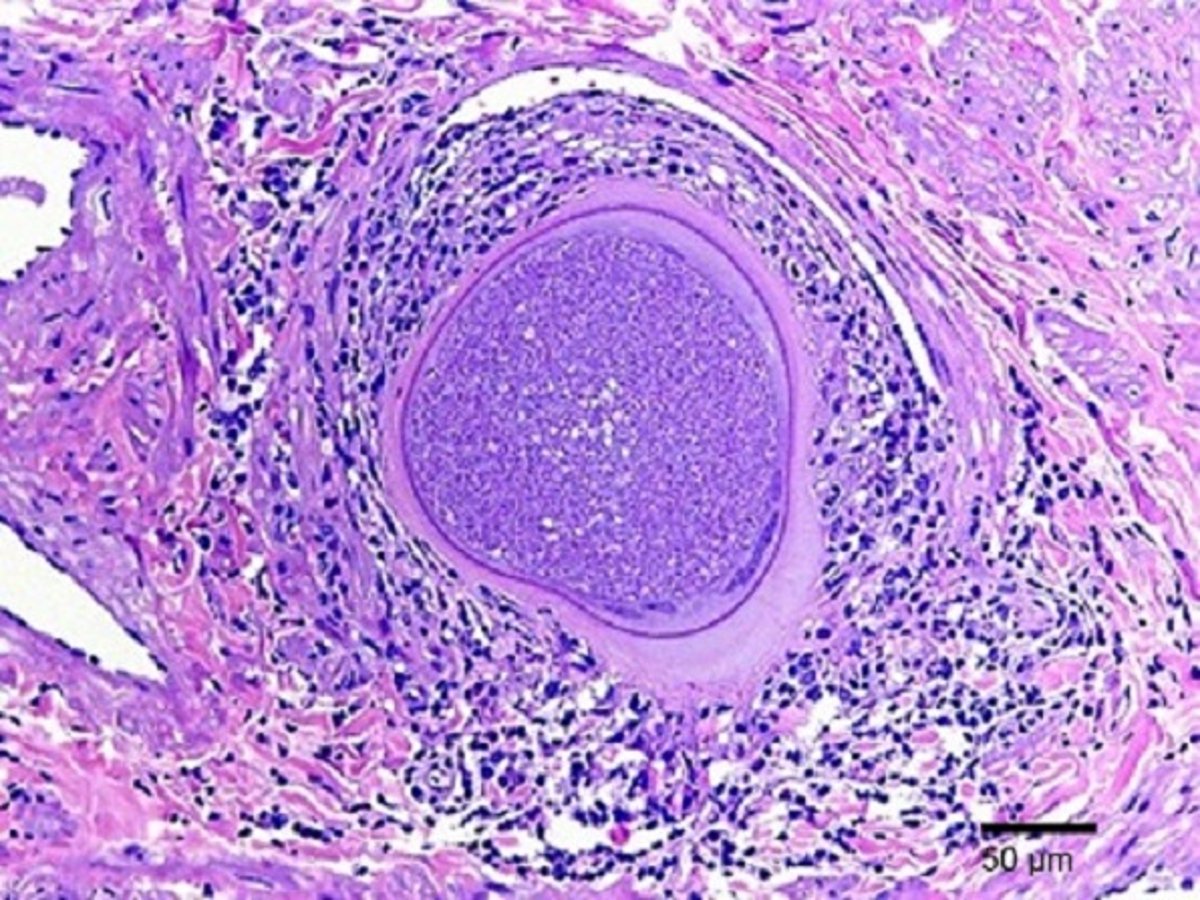 Pampiniform plexus tissue cysts, bull