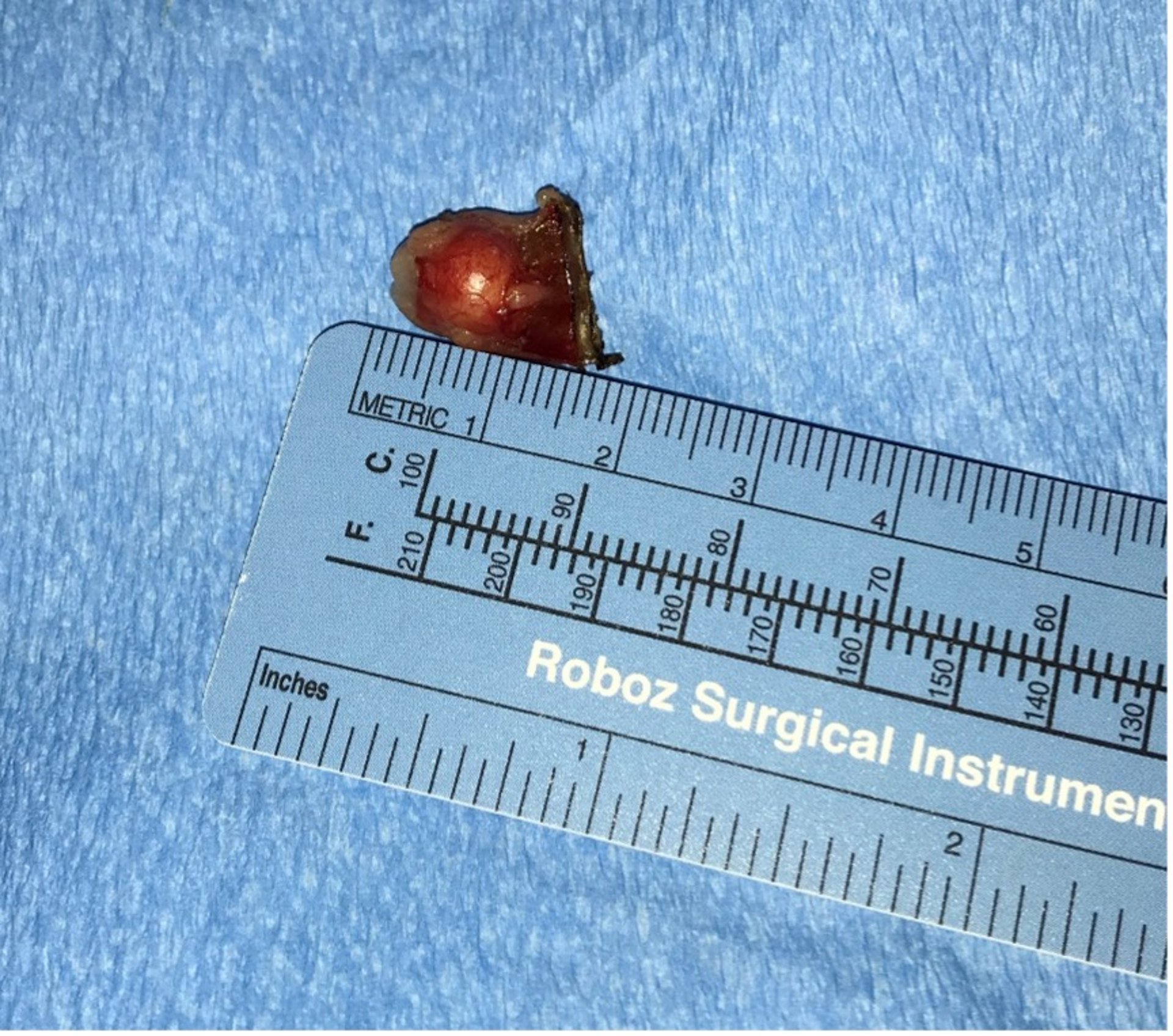 Excised parathyroid nodule, dog