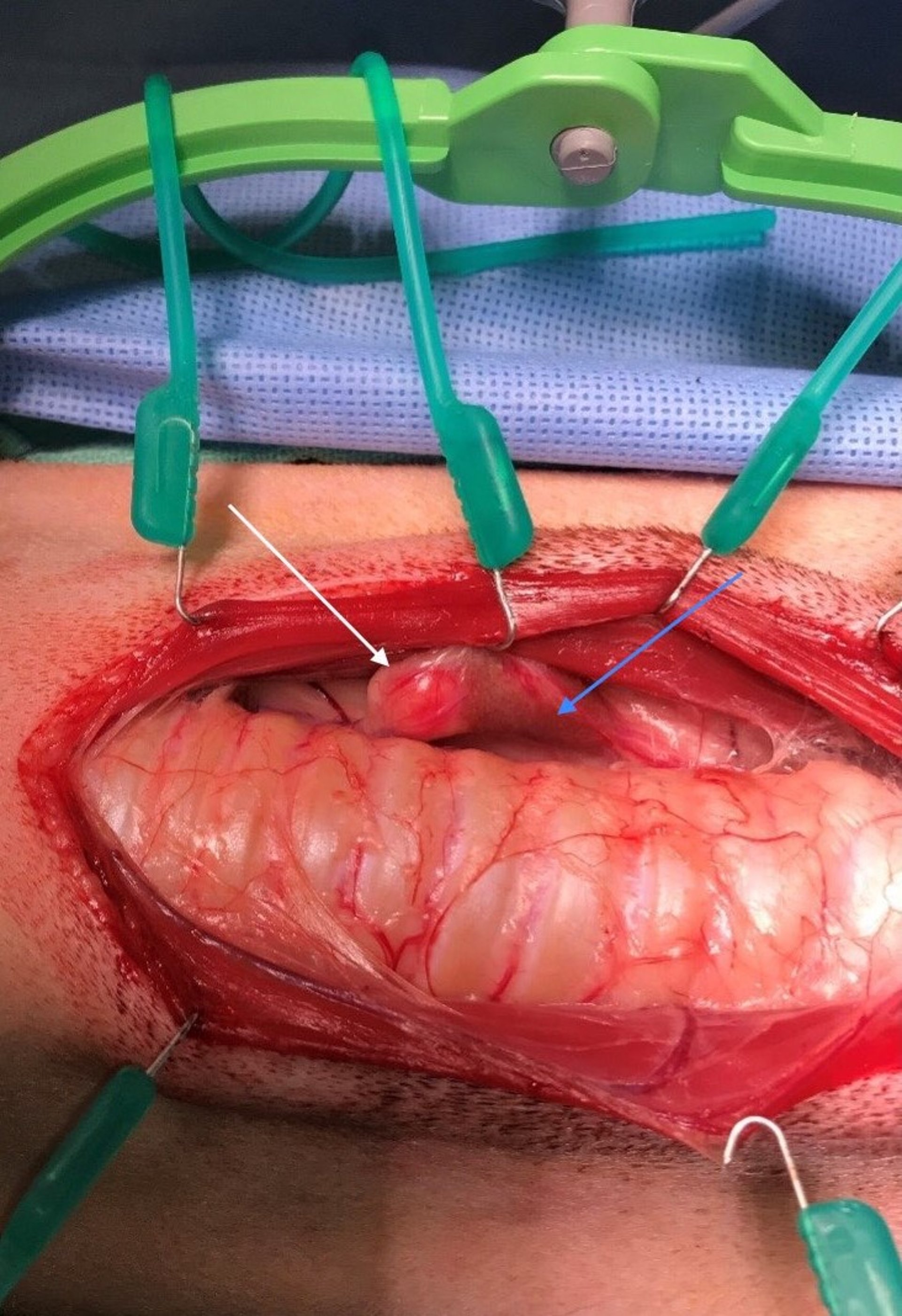 Parathyroid surgery, dog