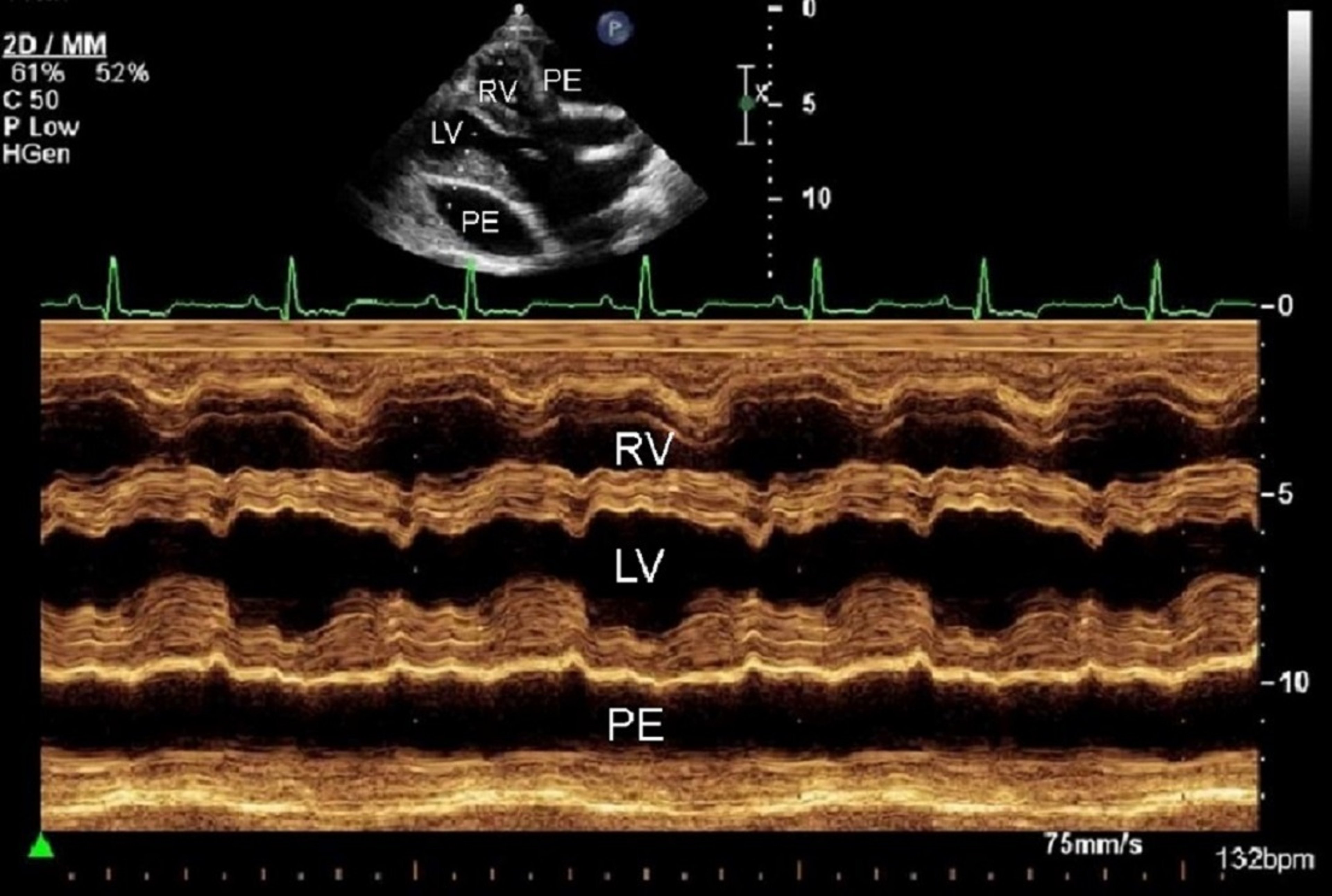 Pericardial effusion, dog, echocardiograms