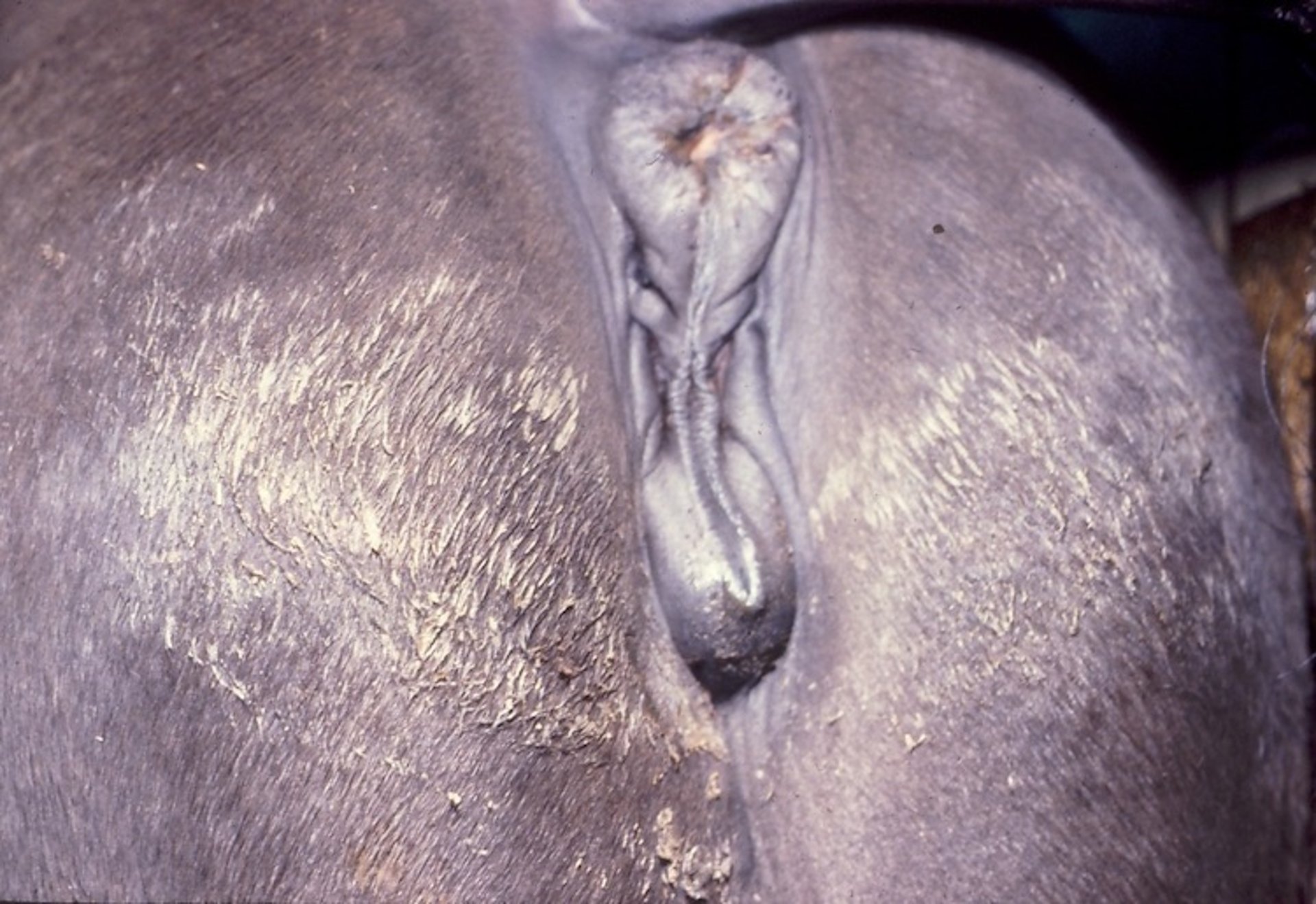 Perineal exudate