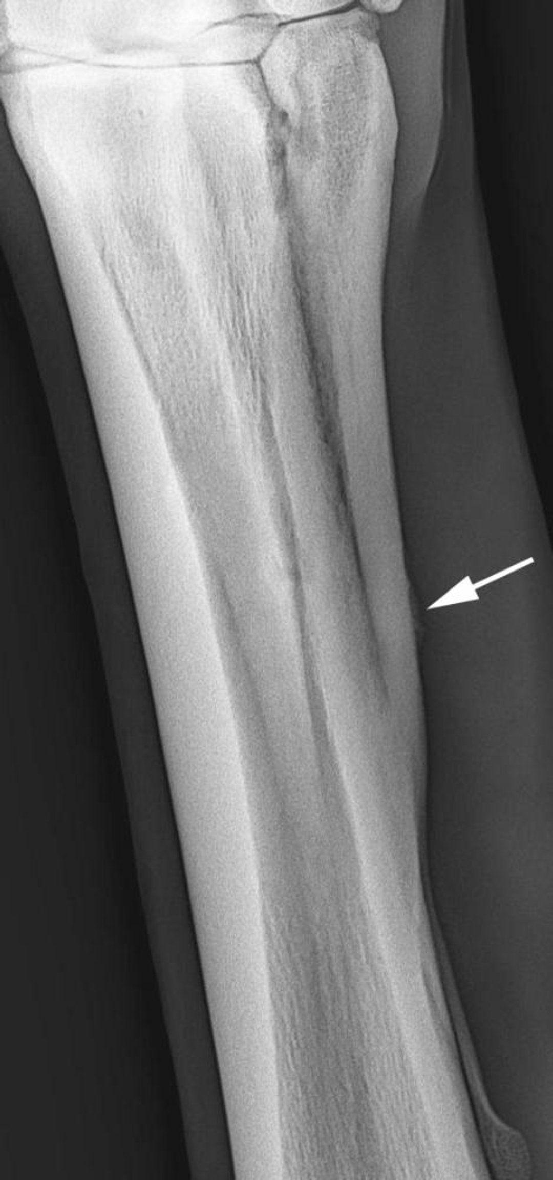 Periosteal new bone on second metacarpal, radiograph, horse