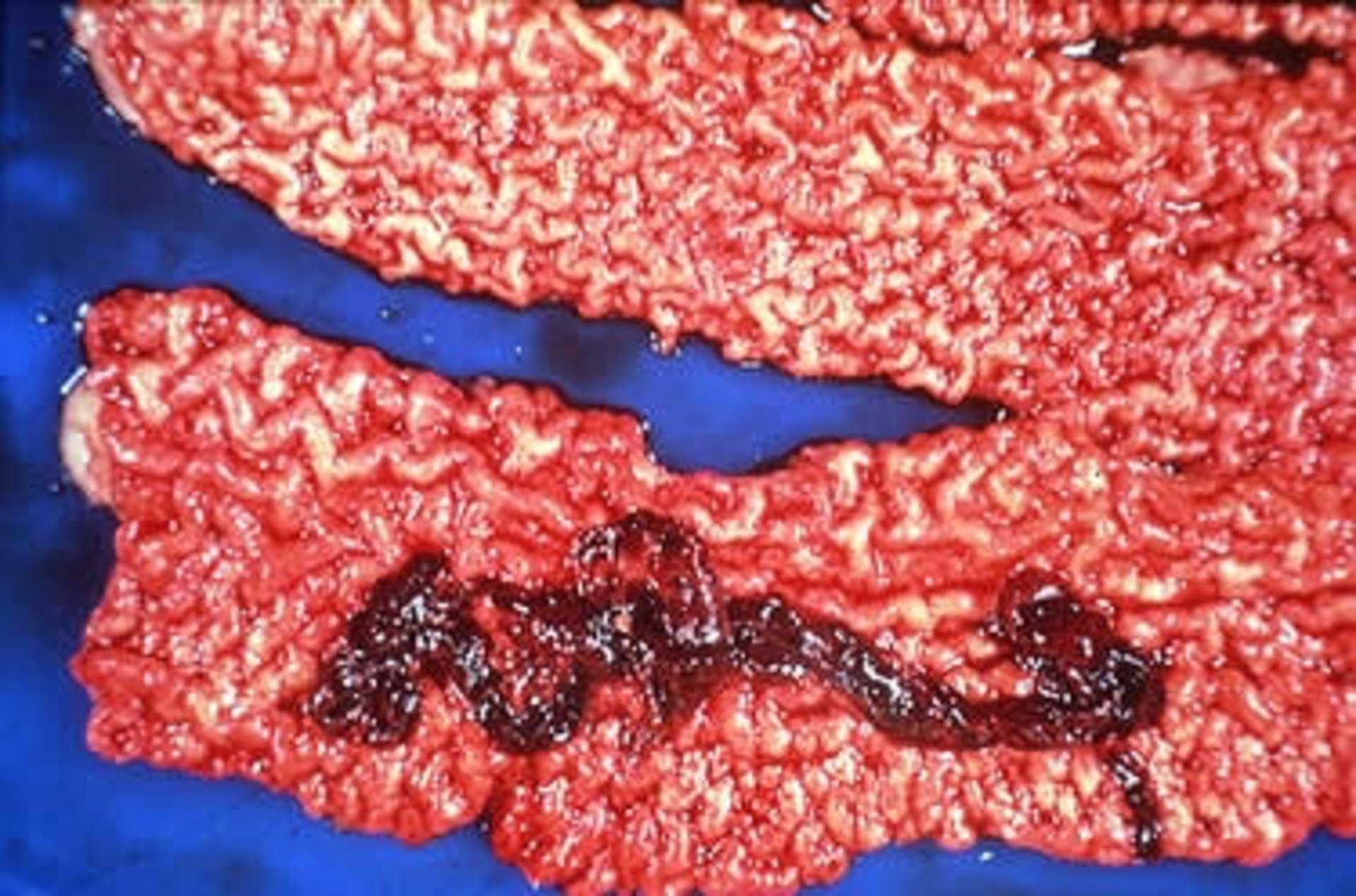 Porcine proliferative enteropathy, pig