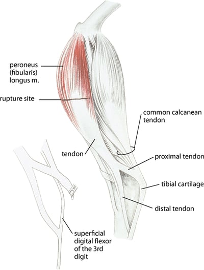 Rupture of the peroneus (fibularis) longus muscle in a turkey