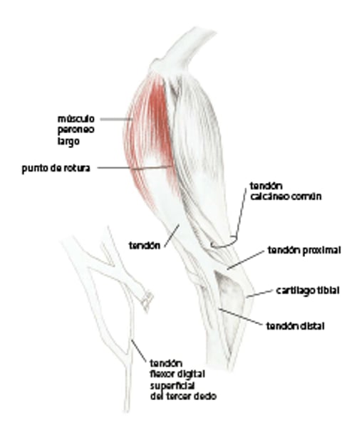 Rotura del músculo peroneo (fibularis) longus en un pavo