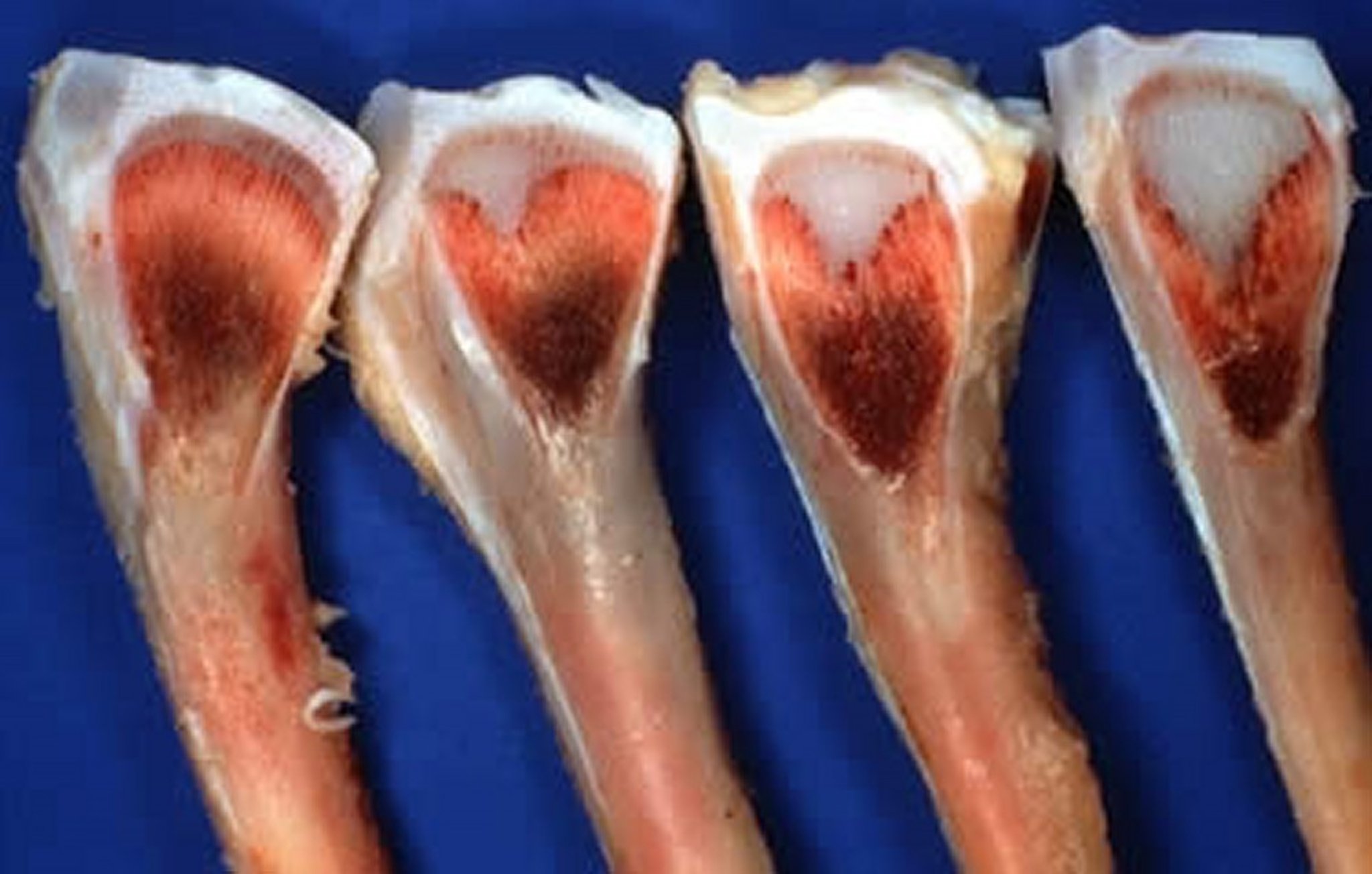 Tibial dyschondroplasia, degrees of severity