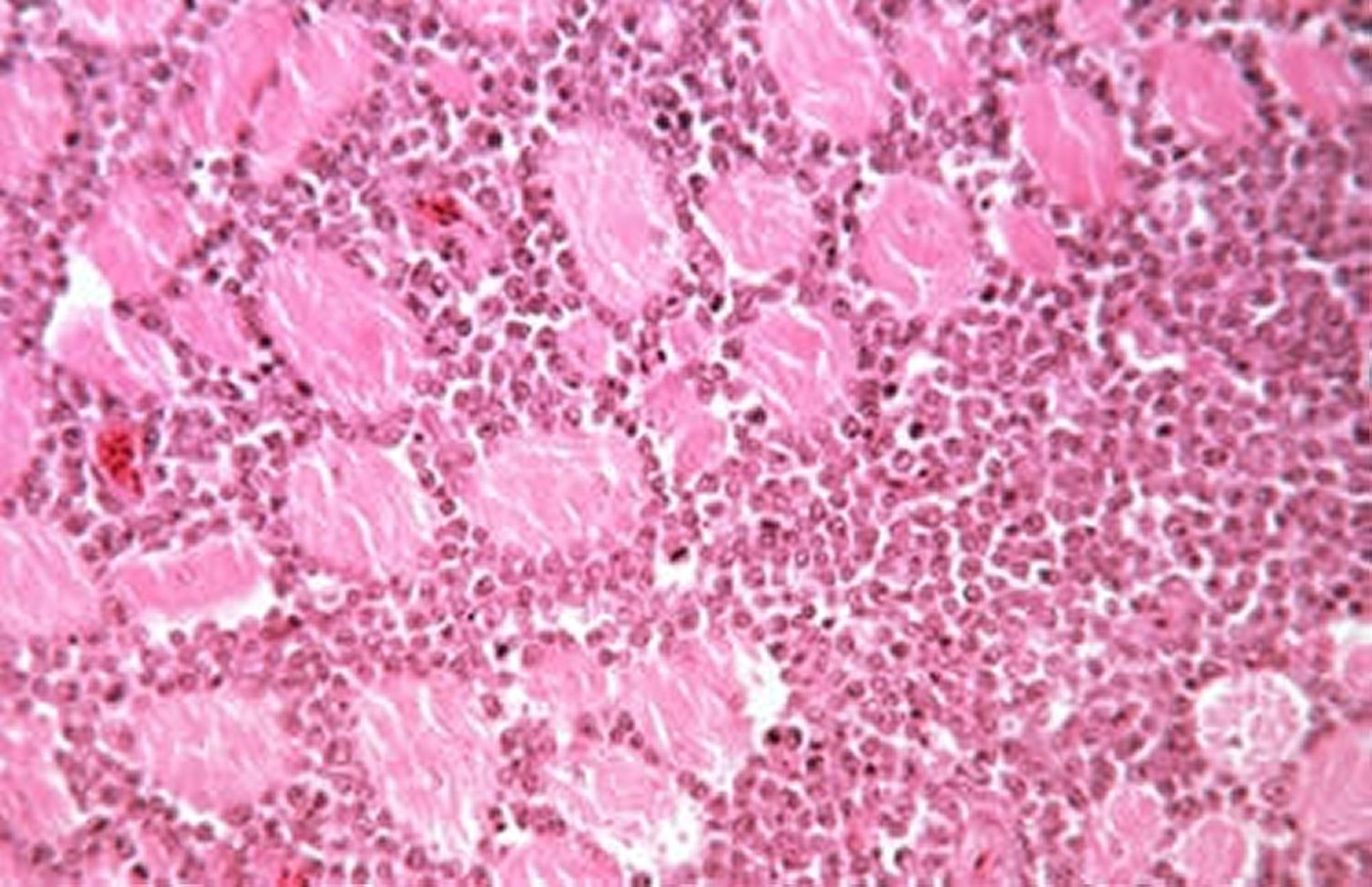 Lymphoid leukosis, lymphocytic infiltration, muscle