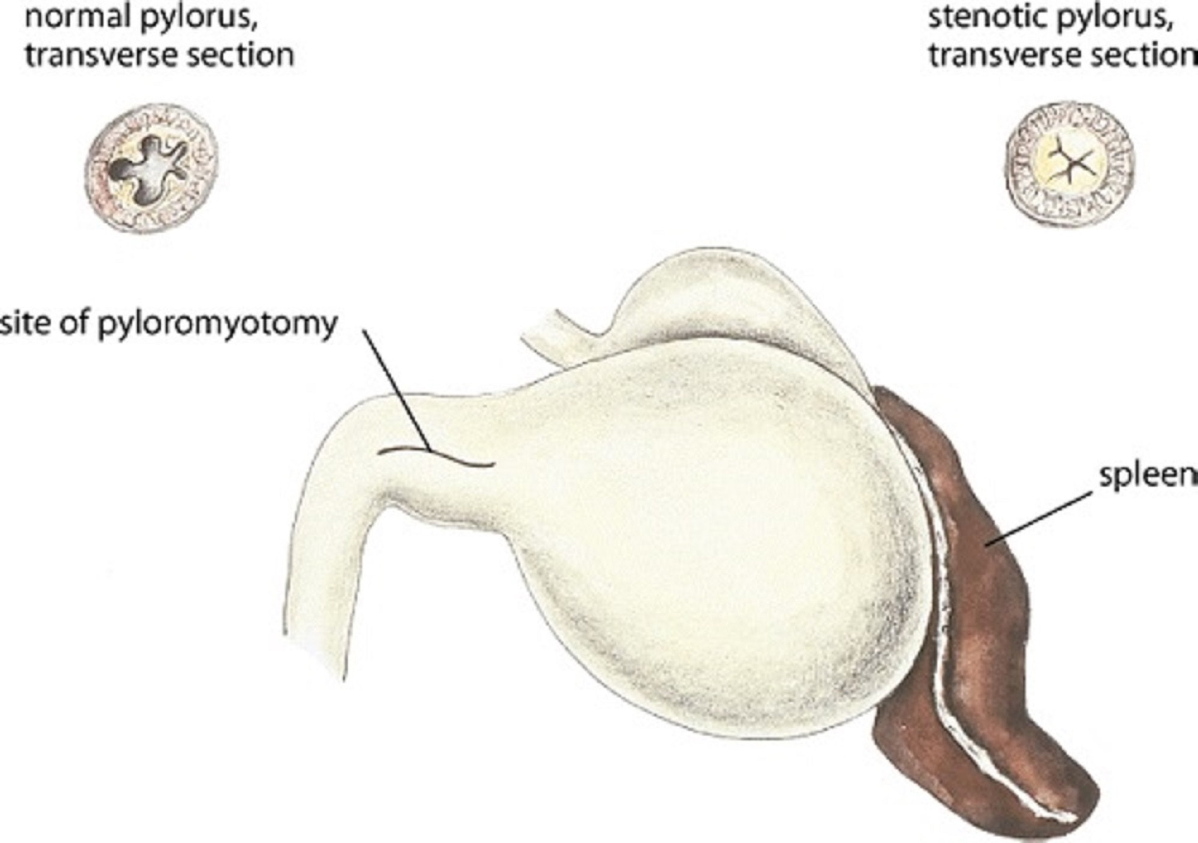 Pyloric stenosis, pyloromyotomy site