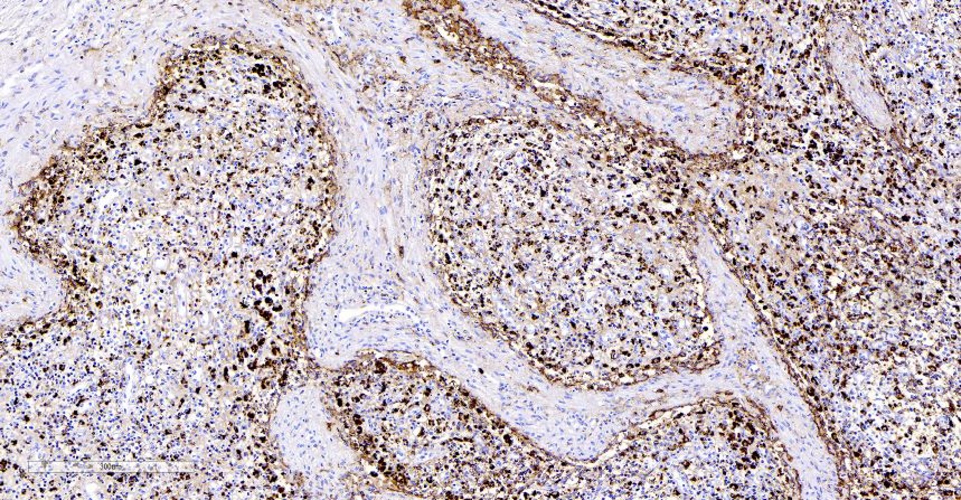 Porcine circovirus 2antigen detection by immunohistochemistry, photomicrograph, pig