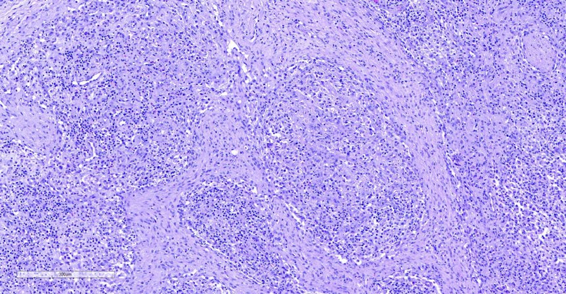 Porcine circovirus 2 systemic disease, photomicrograph, pig