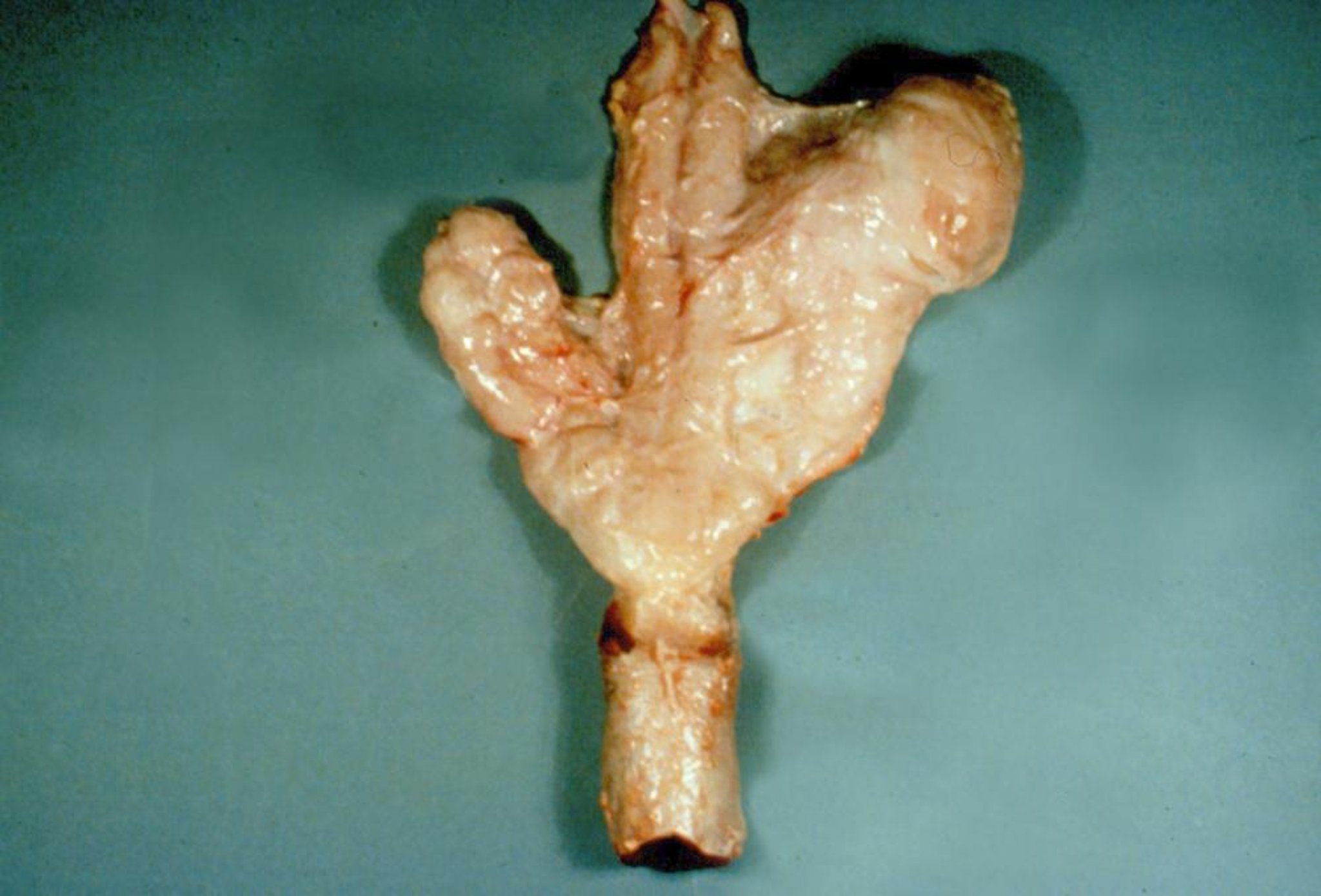 Pelvic genitalia, unilateral vesiculitis, dairy bull