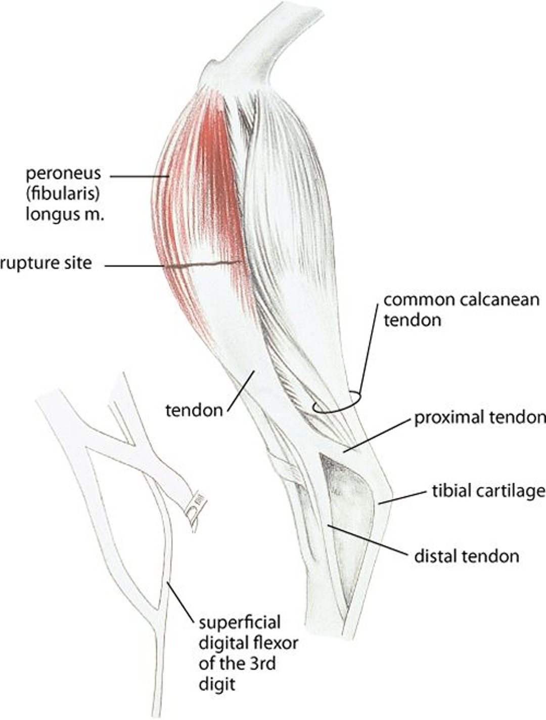 Local da ruptura do músculo peroneo longo (fibular), peru