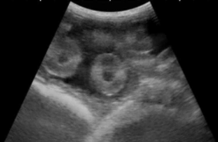 Placentomes, ultrasonogram, ewe