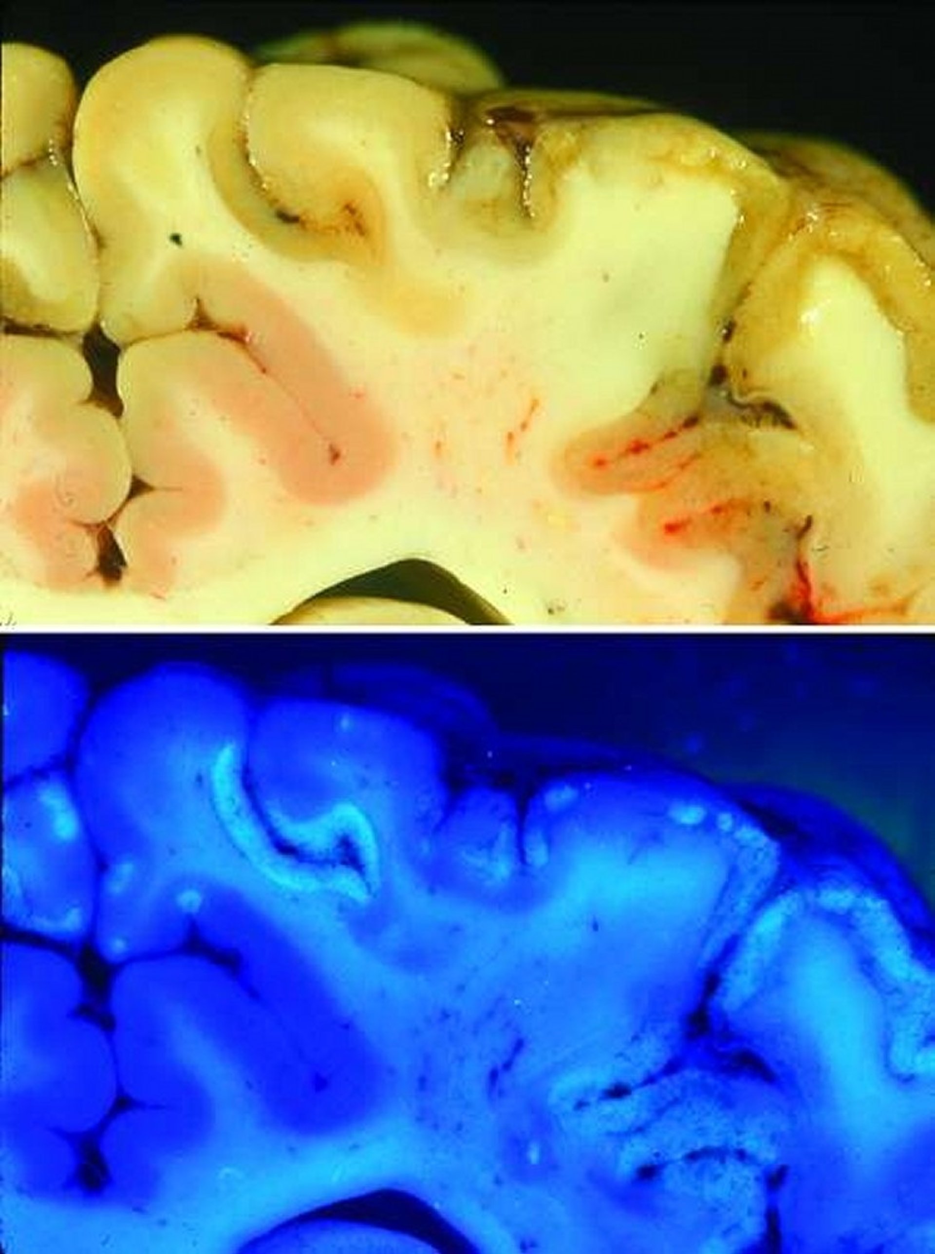 Polioencephalomalacia, cortex, postmortem, feedlot steer