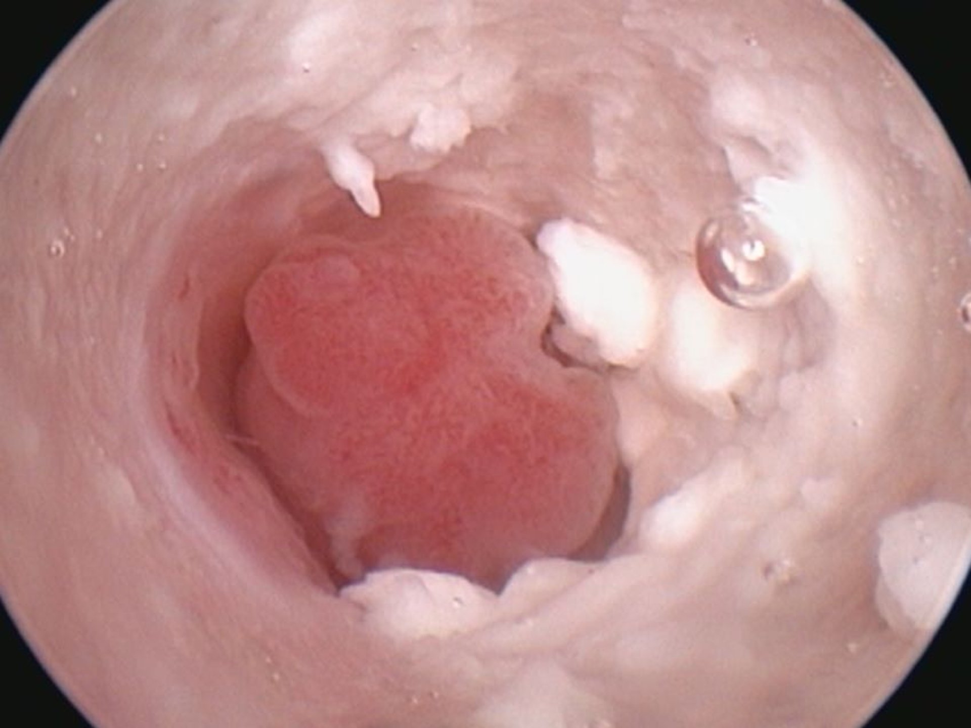 Nasopharyngeal polyp, otoscopic image, cat