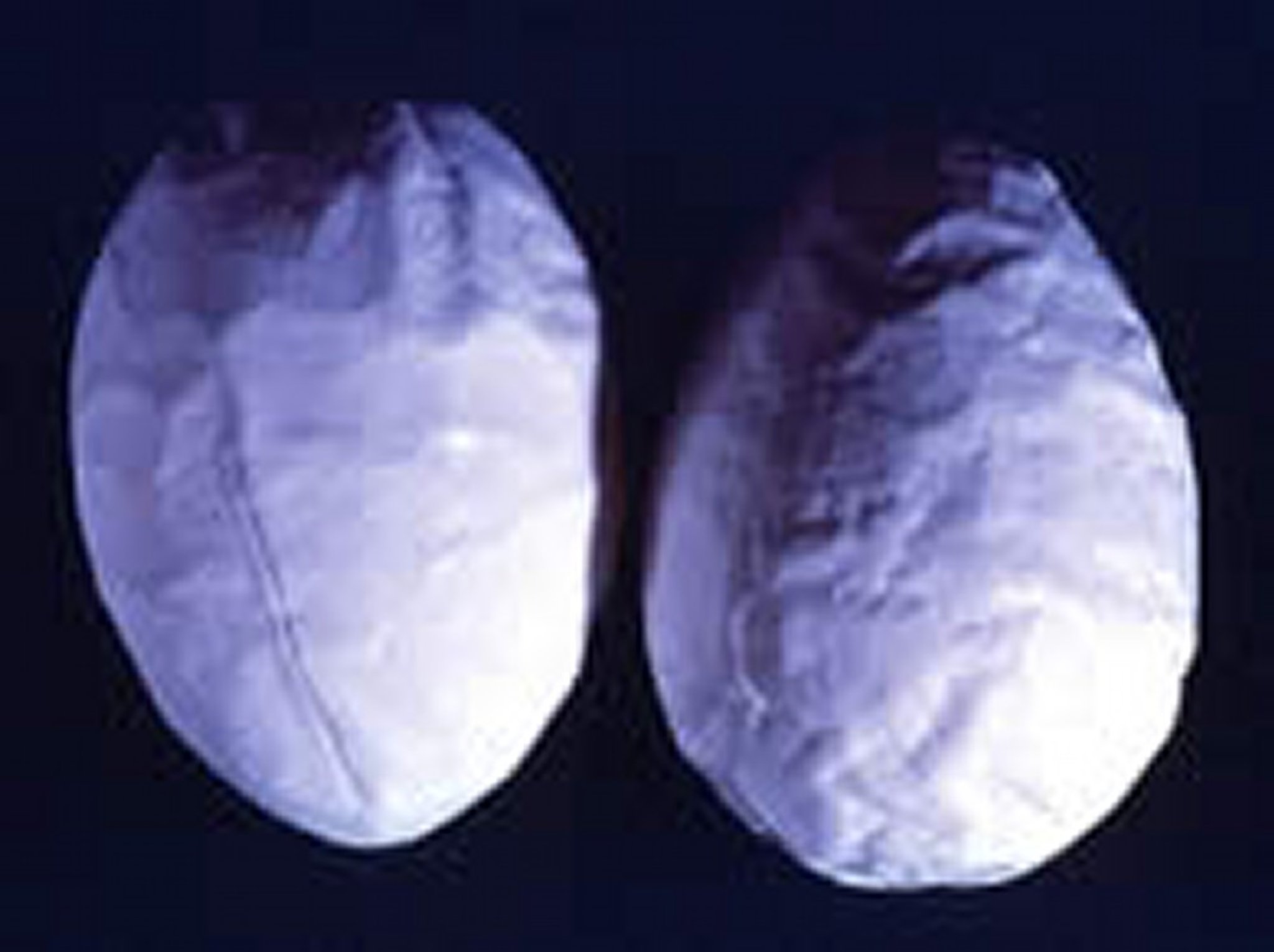 Bronquitis infecciosa, cáscaras de huevo arrugadas