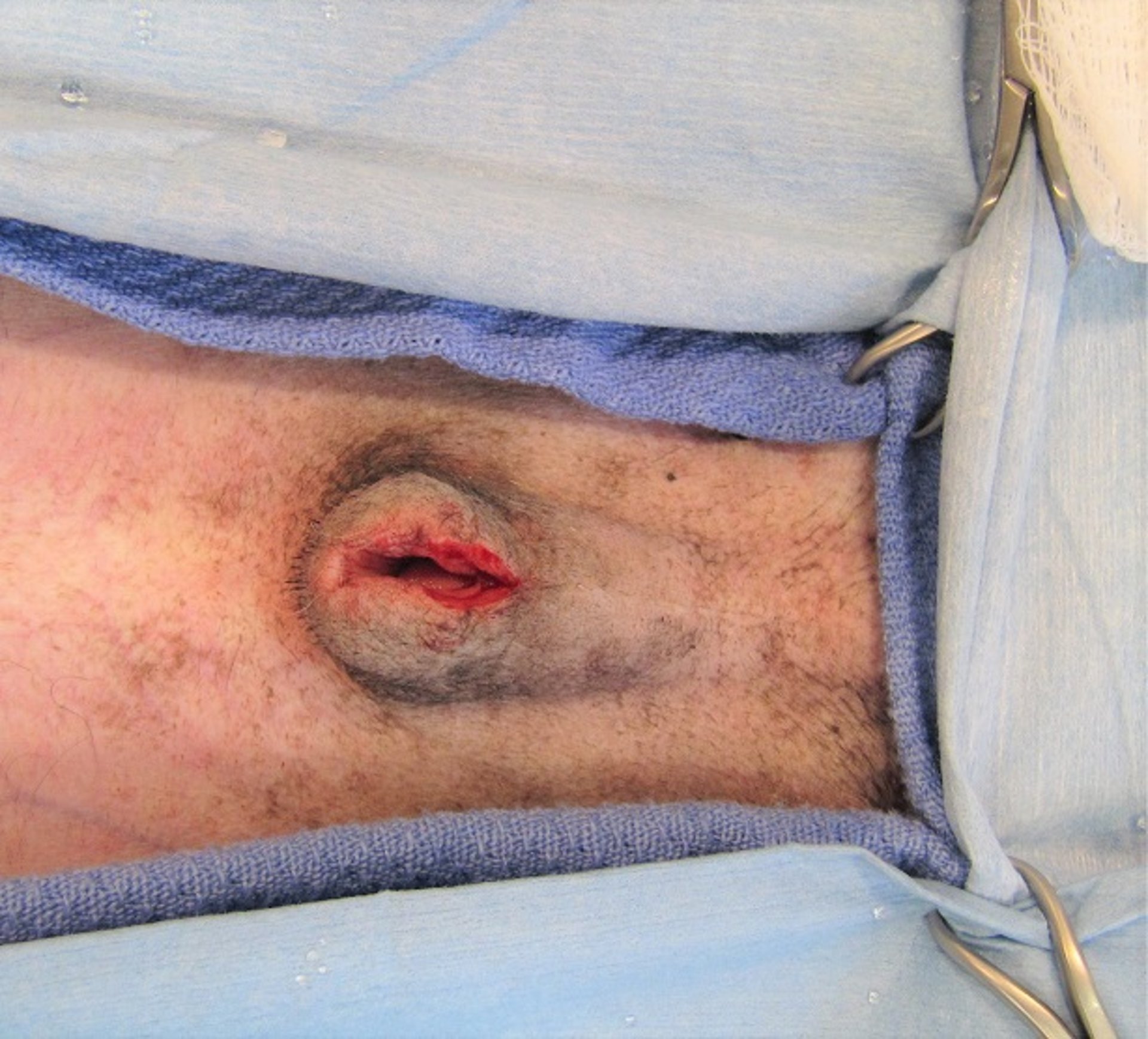 Preputial orifice revision for paraphimosis, dog