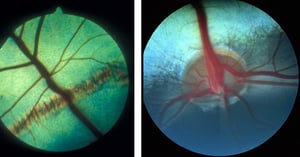 Coriorretinitis previa y fondo normal, vaca