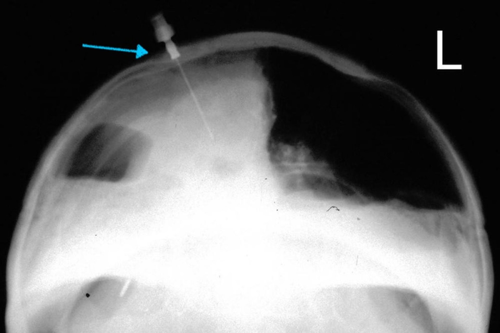 Candidiasis pulmonar, tortuga