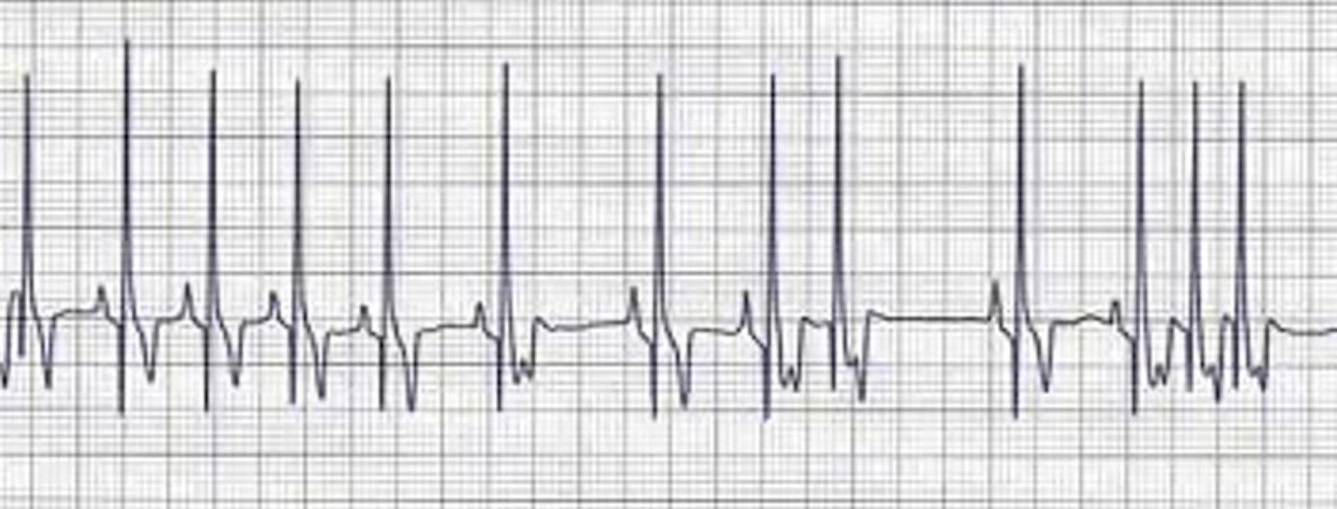 Atividade elétrica sem pulso, traçado do ECG