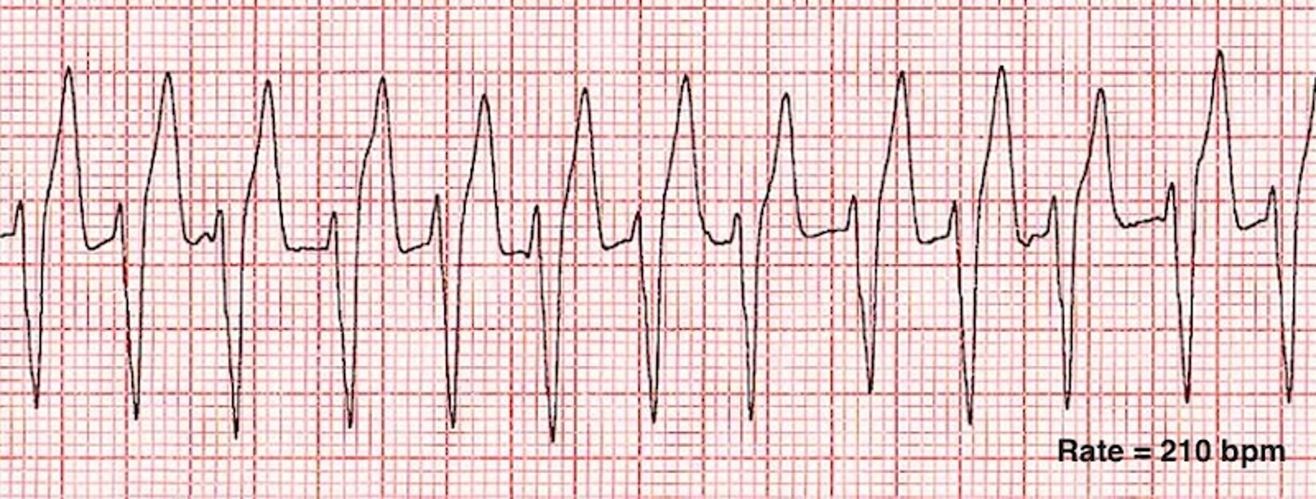 Taquicardia ventricular sem pulso, traçado de ECG