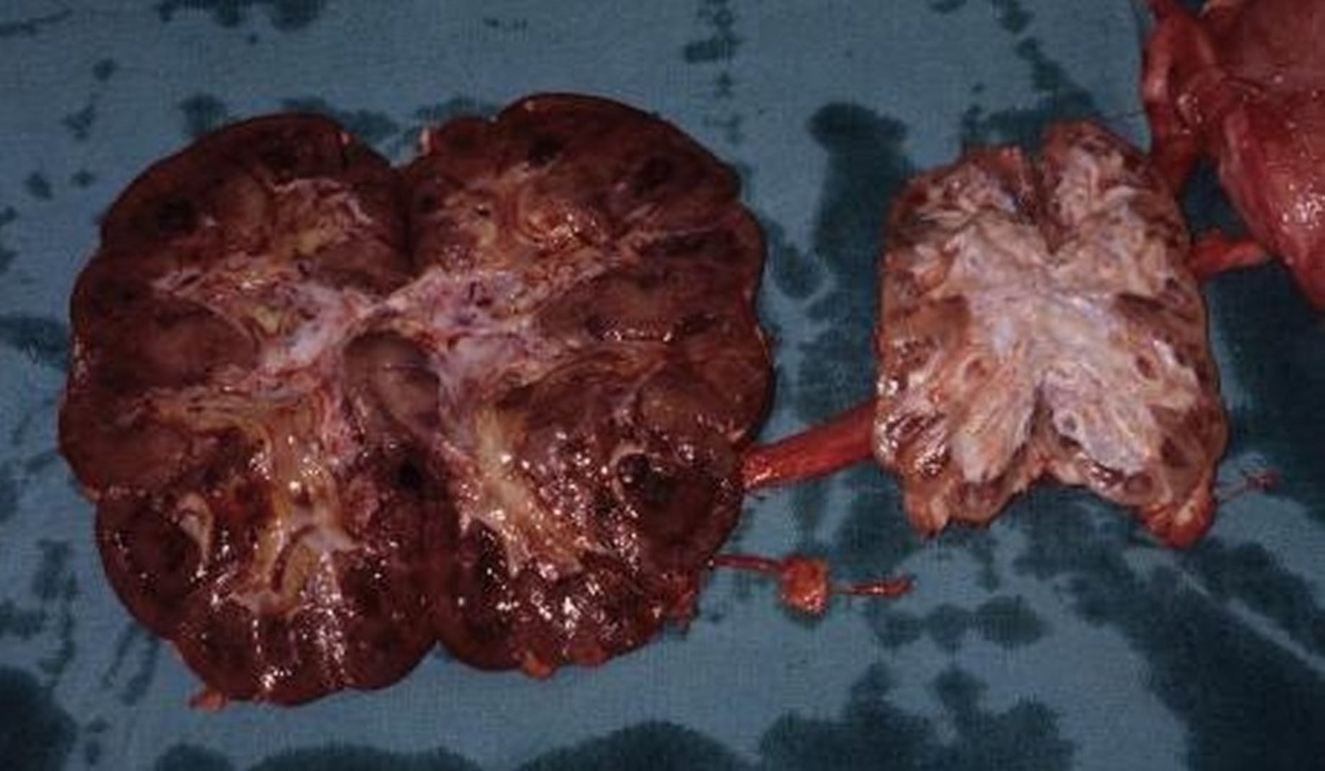 Pielonefritis aguda y crónica, vaca