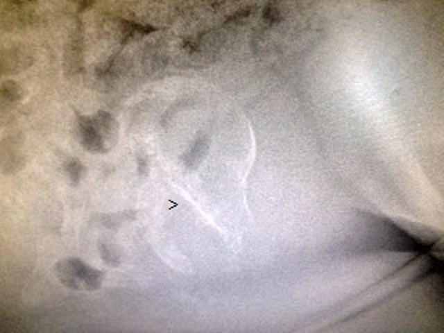 Radiograph of a fetus