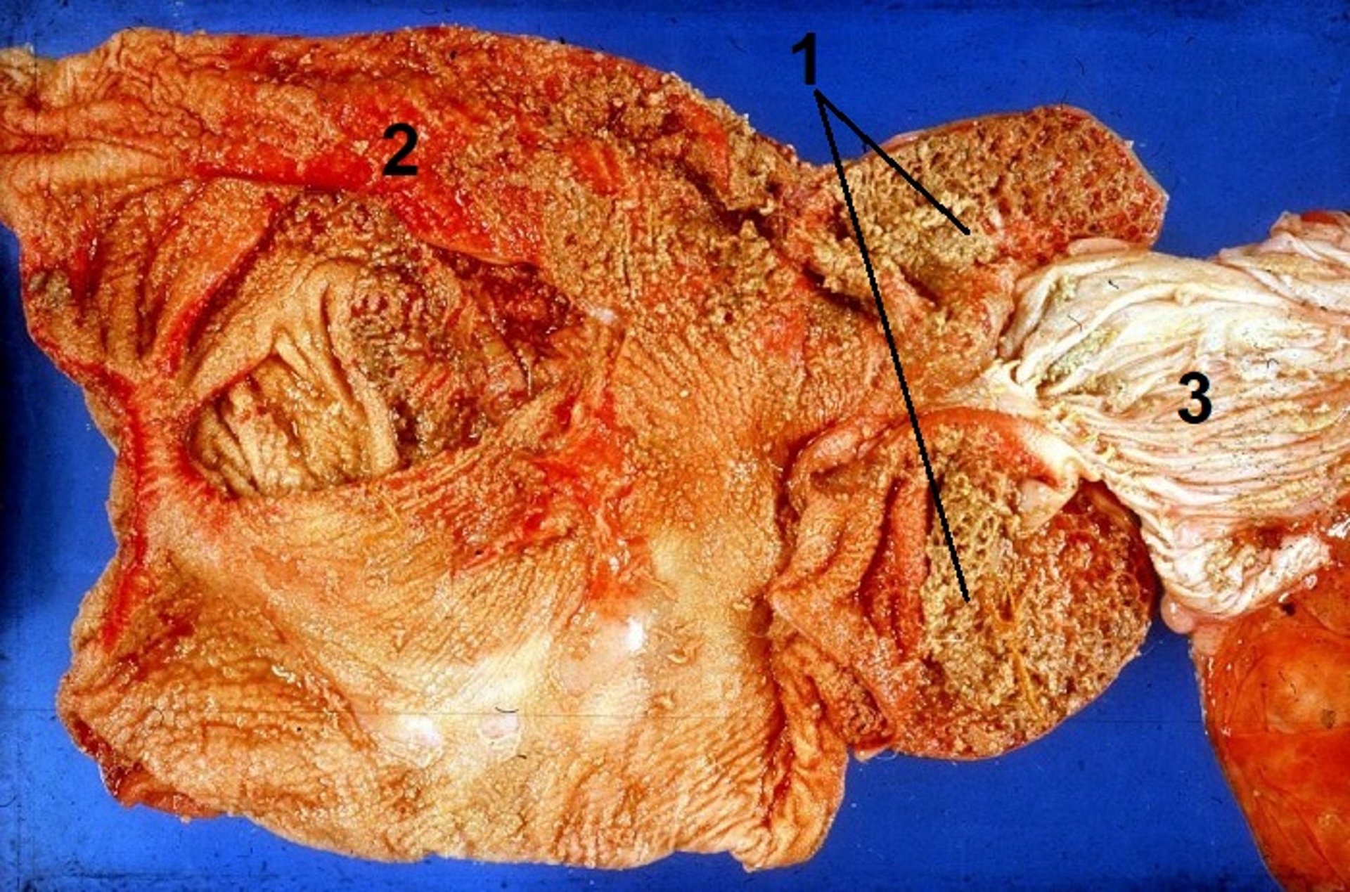 Reticulorumenitis, calf