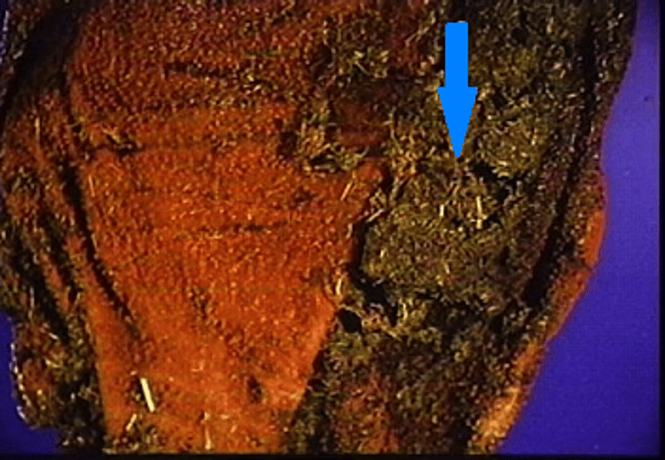 Rumen sloughing, bovine