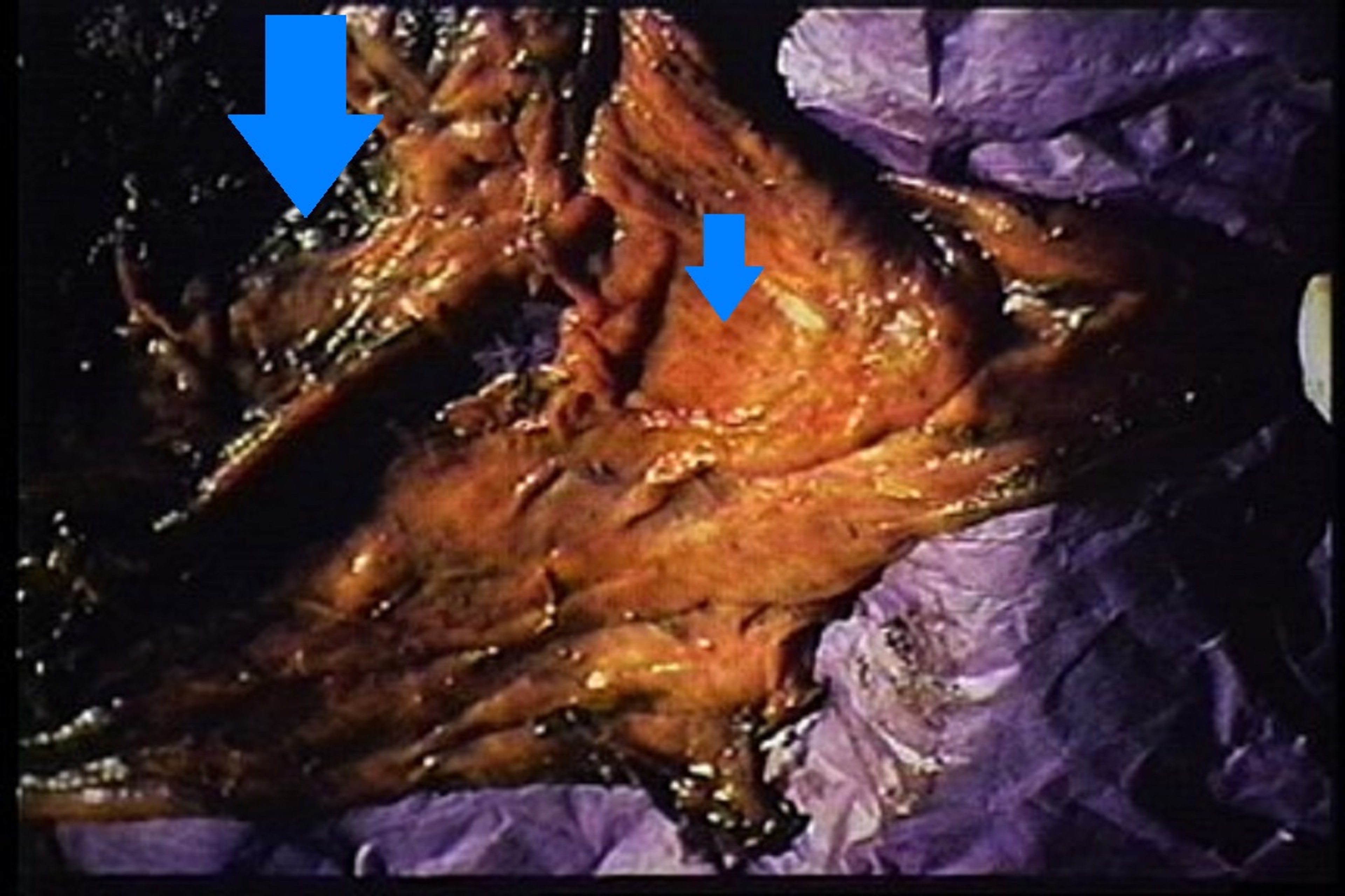 Rumen ulceration and hemorrhage, bovine