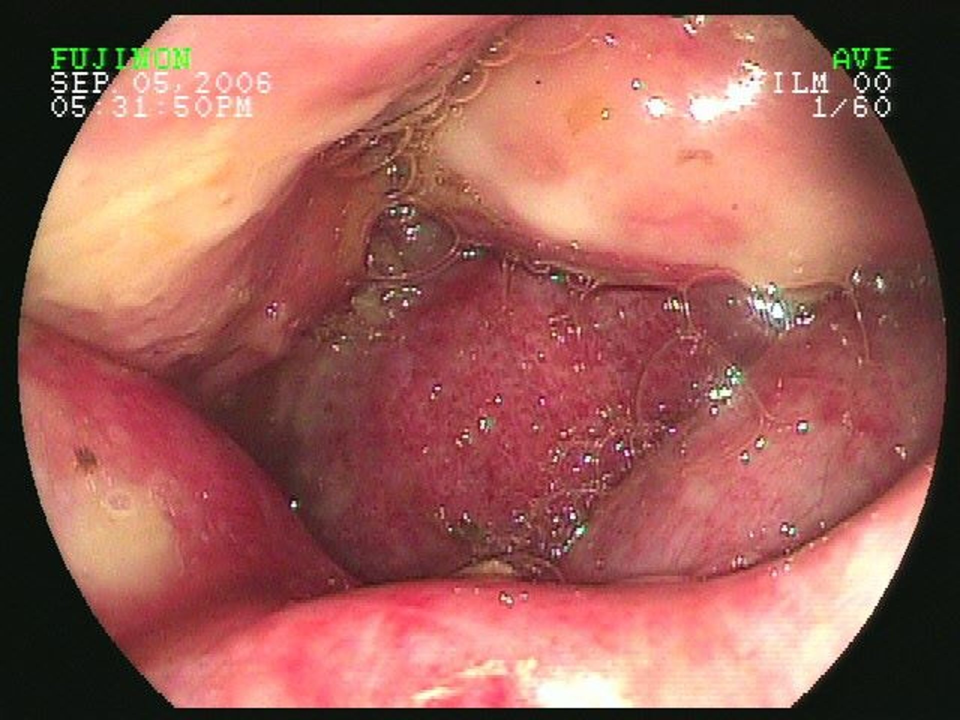 Rectal tear, colonoscopic image, horse