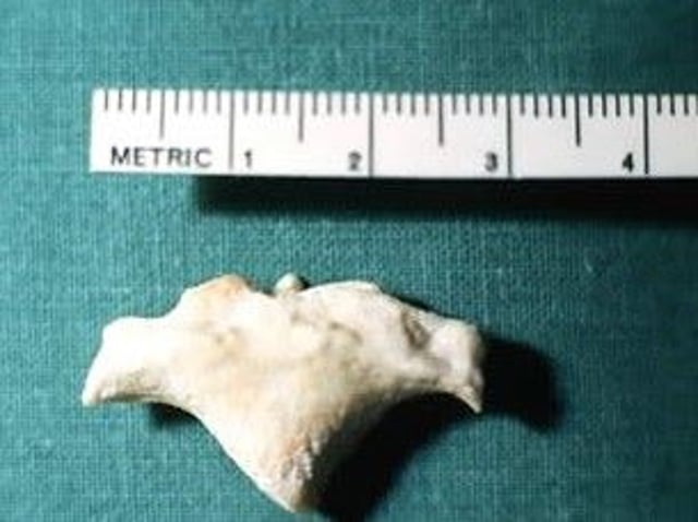 Cálculo renal, collie