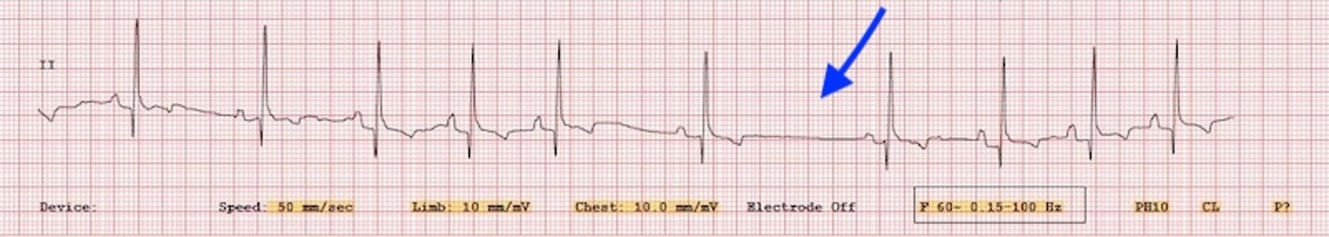 Arritmia sinusal respiratoria, ECG, perro