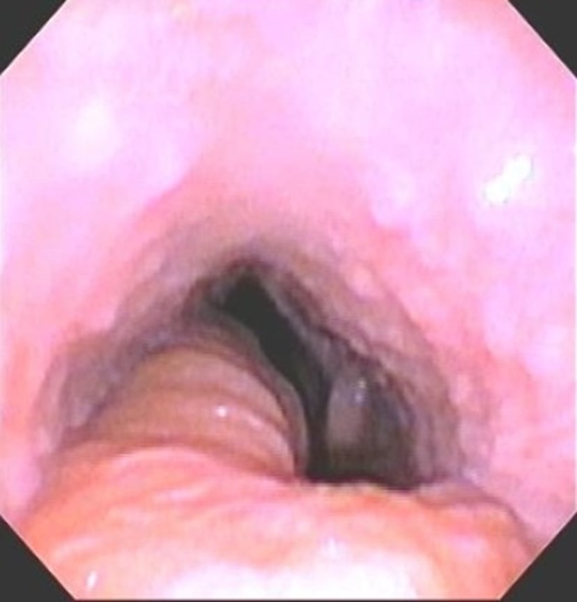 Retropharyngeal lymphadenopathy and airway obstruction, horse
