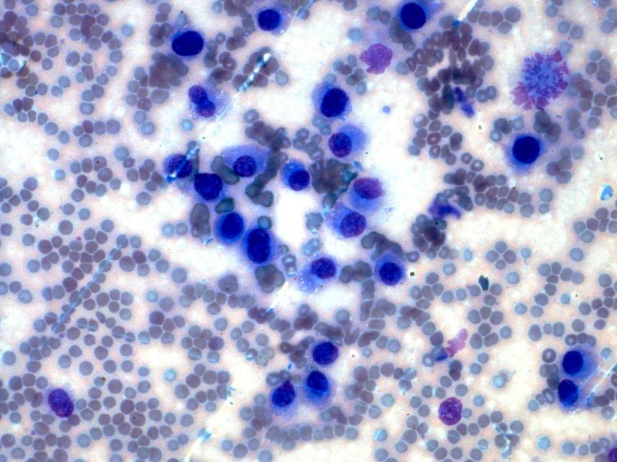 Células redondas (plasmocitoma)