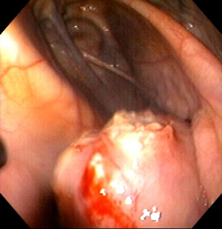Rotura de un absceso retrofaríngeo por <i >Streptococcus equi</i>, caballo