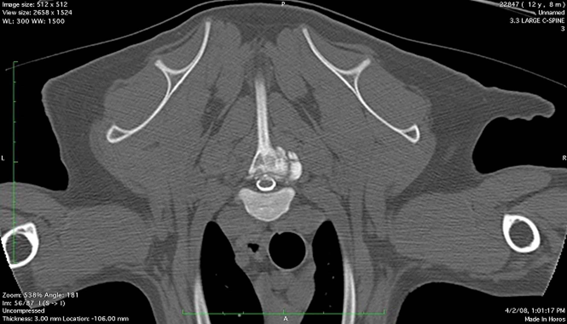 Multiple cartilaginous exostoses