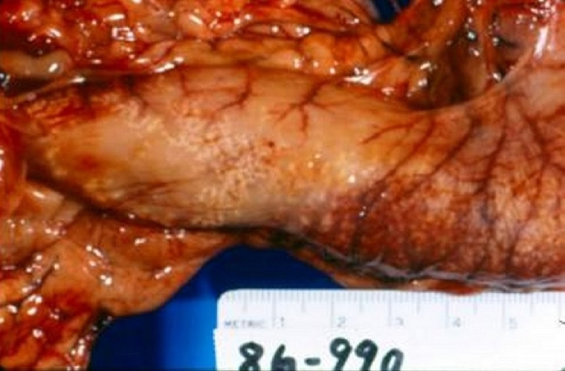 Serosal calcification, cholecalciferol poisoning
