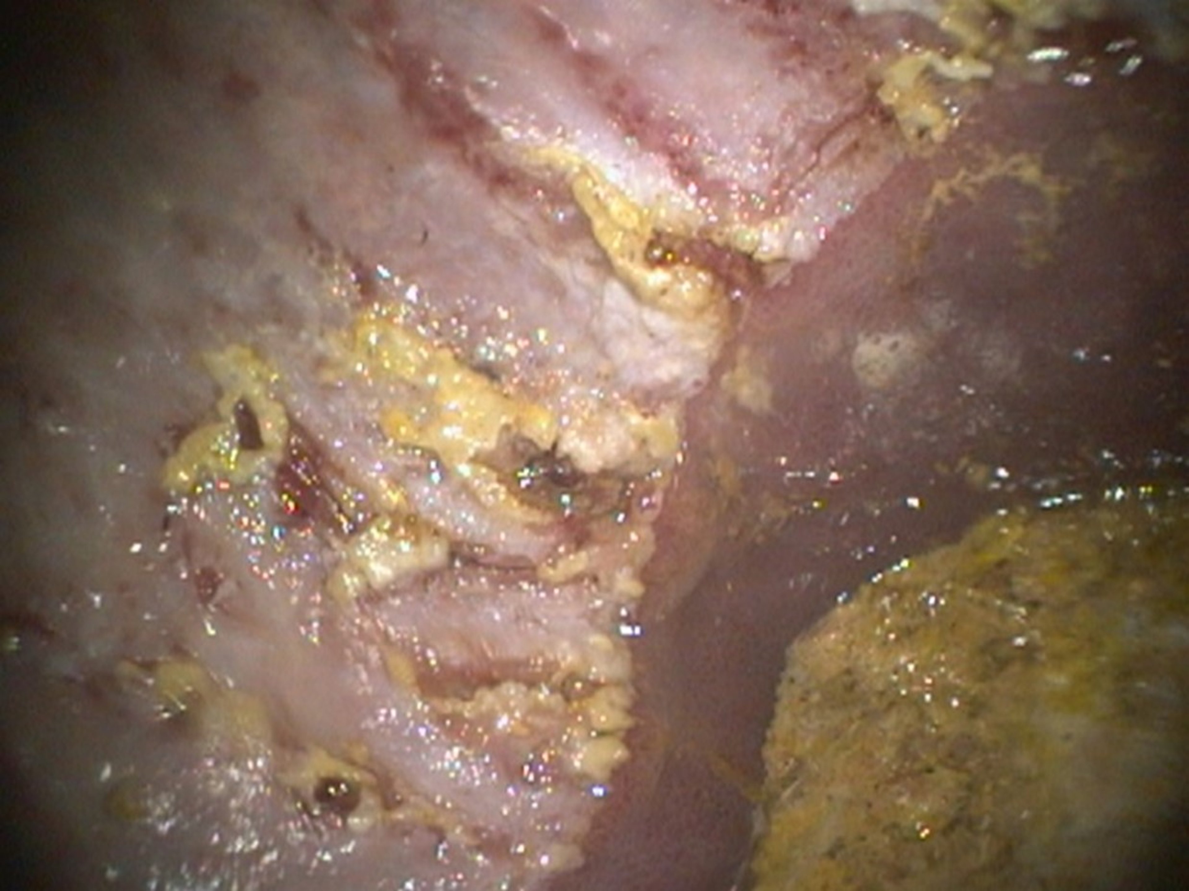 Severe ulceration, nonglandular squamous mucosa, adult horse