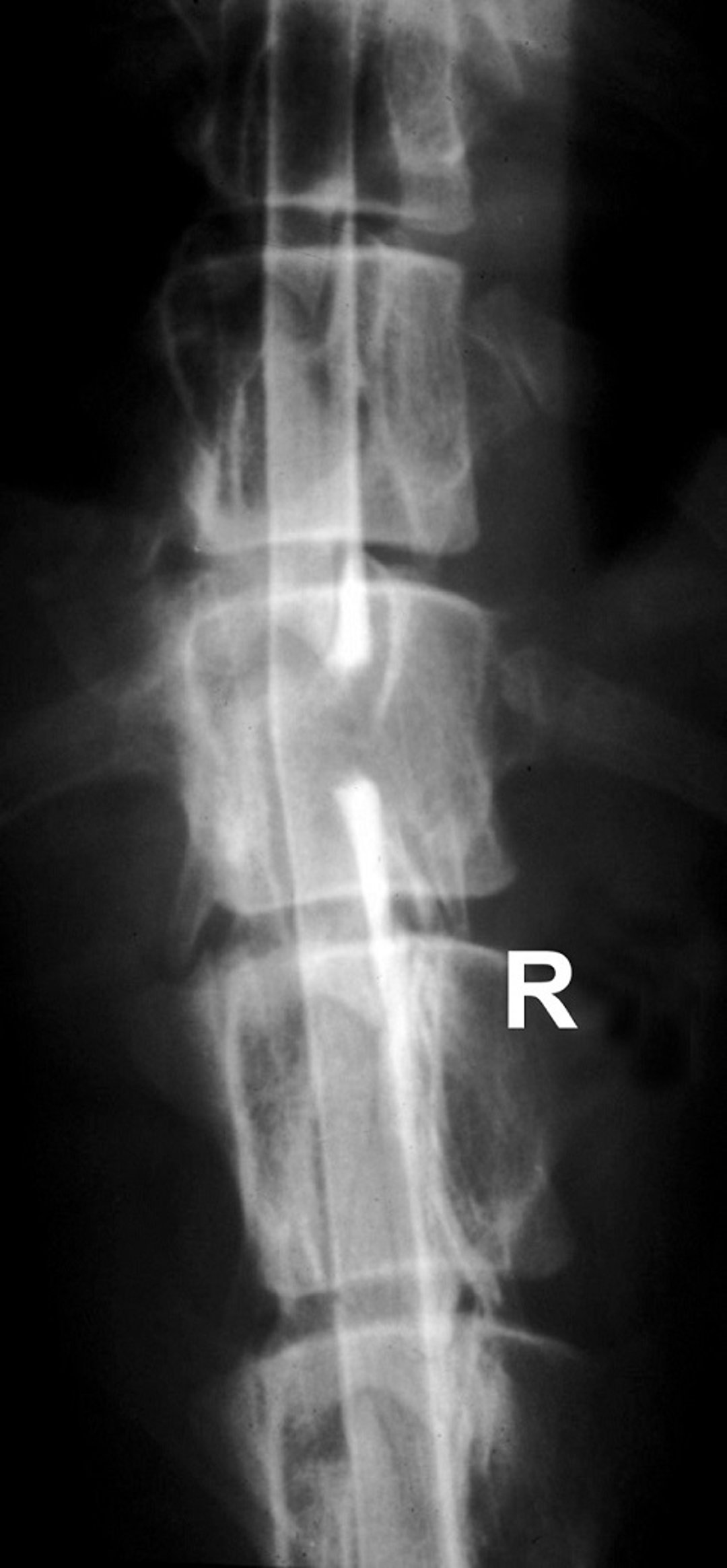 Spinal meningioma, T13, dog, part B