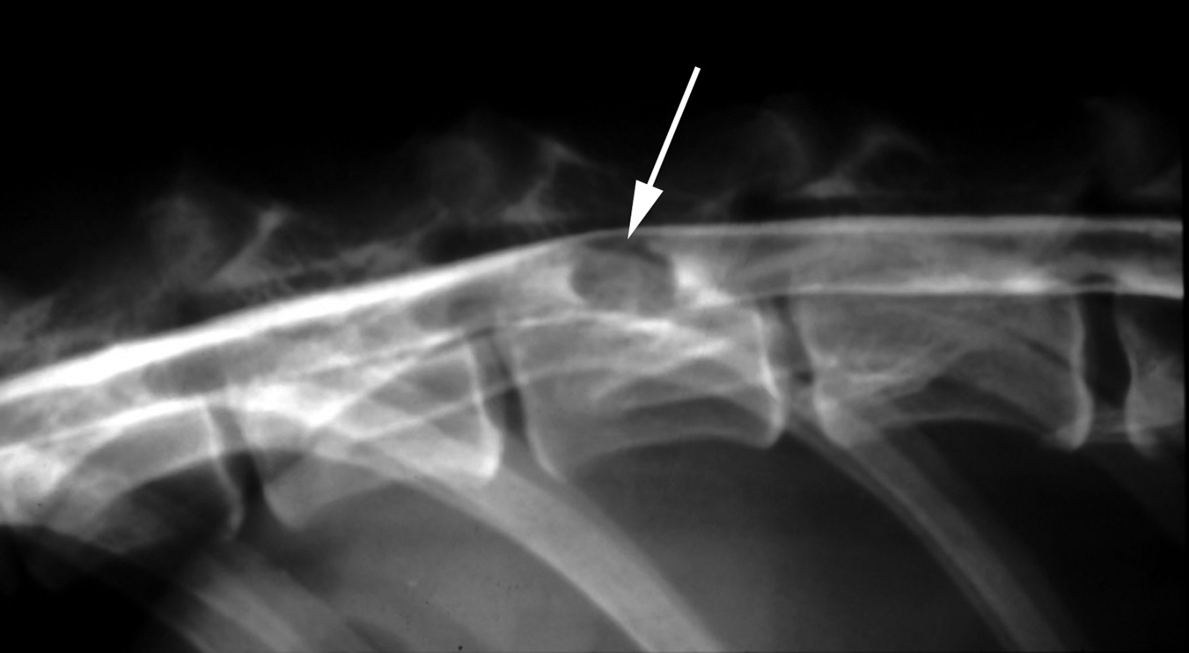 Spinal meningioma, T13, dog, part A