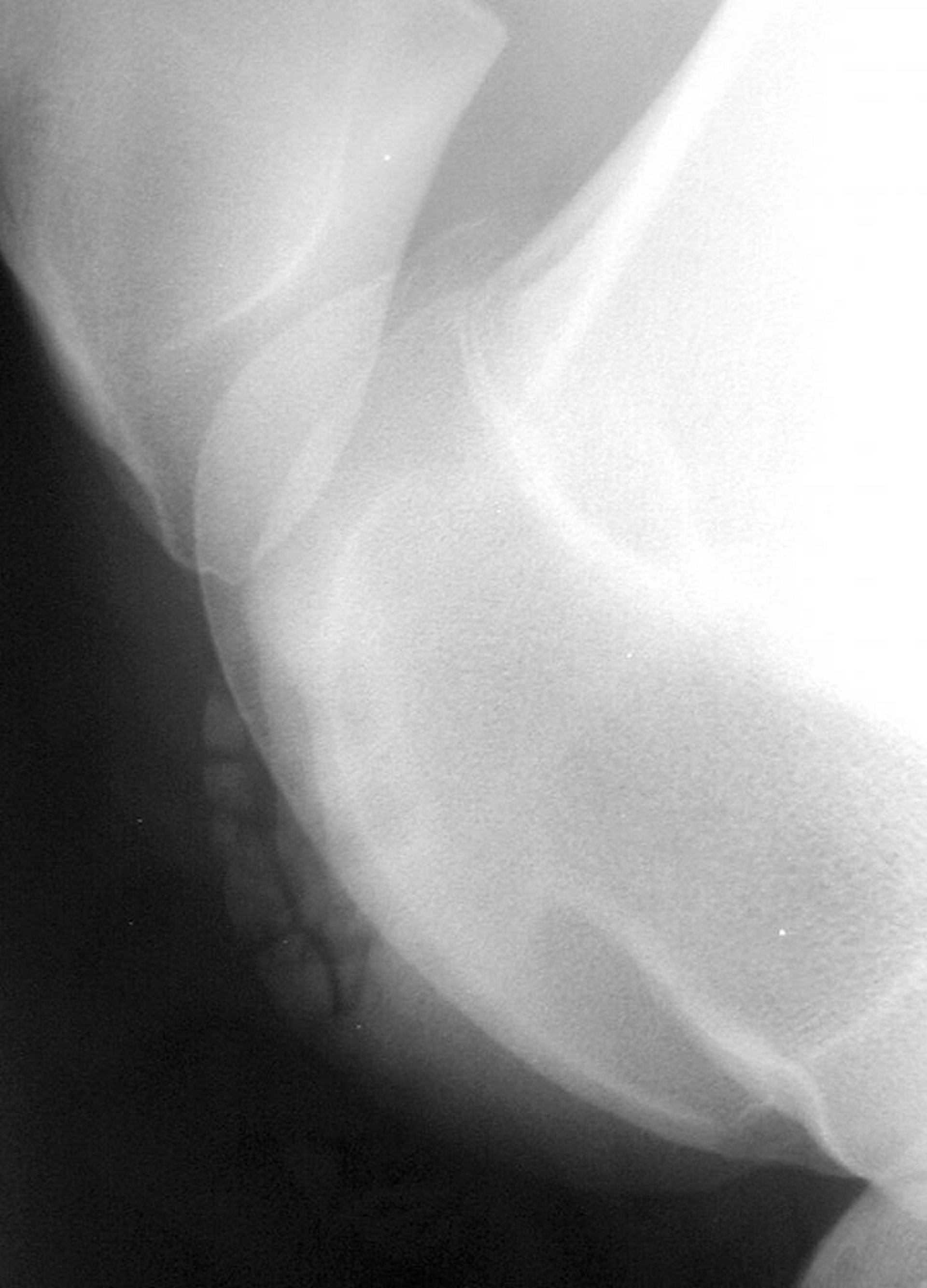 Osteochodrosis lesion, lateral trochlear ridge of the distal femur, stifle joint, horse