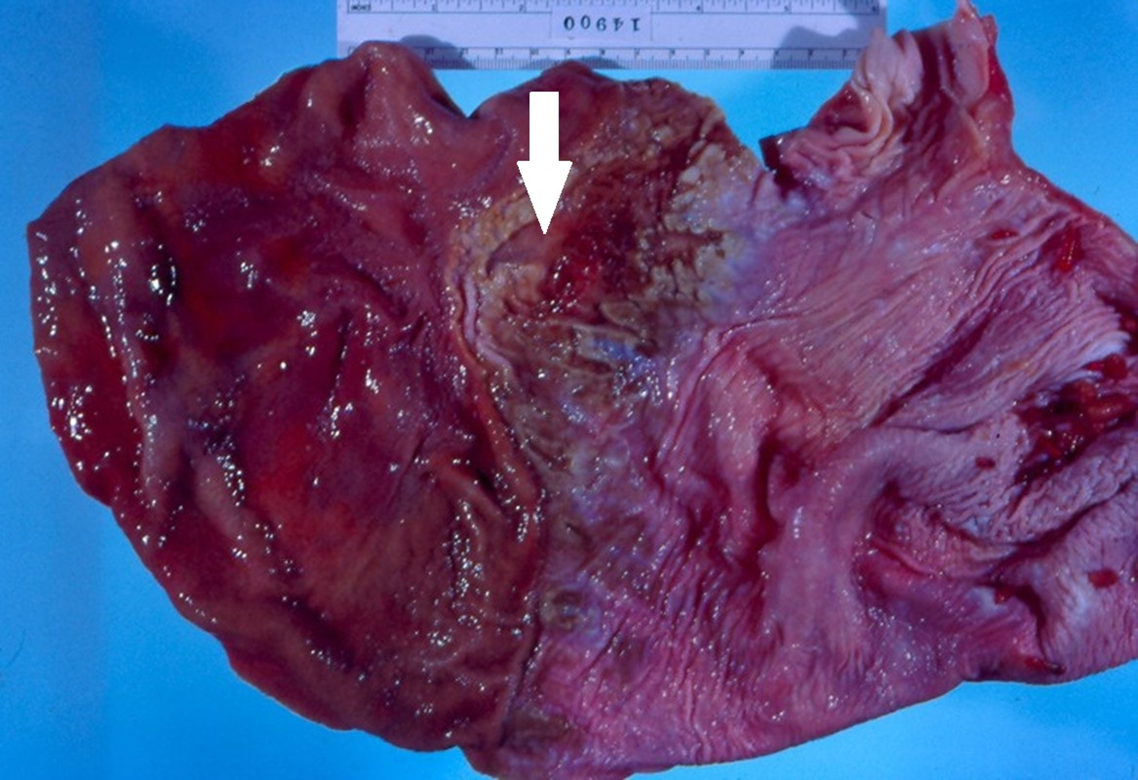 Stomach ulcers, equine