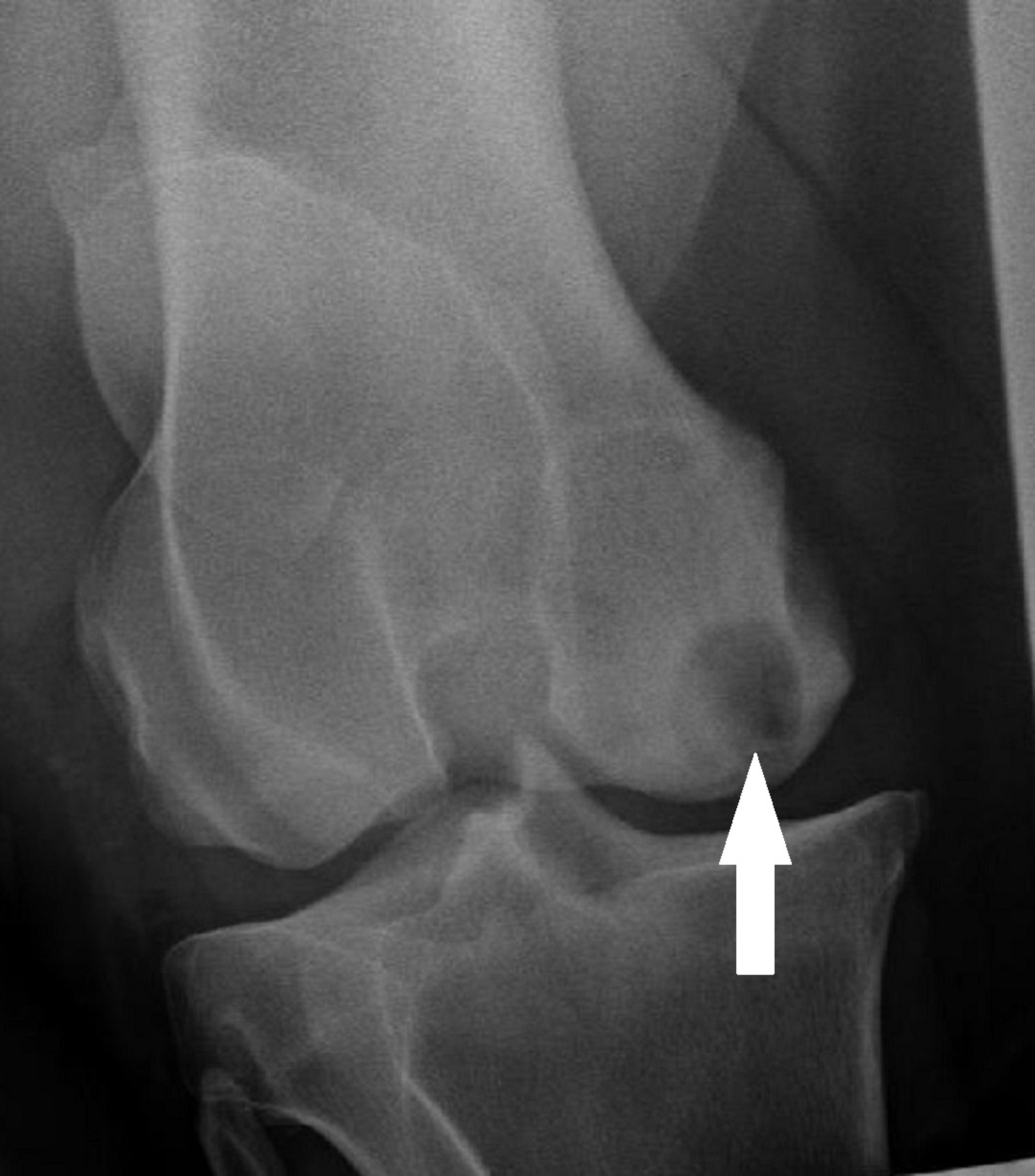 Subchondral bone cyst, horse