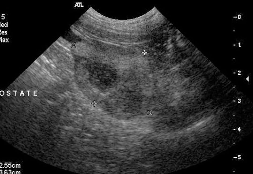 Ecografía sagital, prostatitis bacteriana