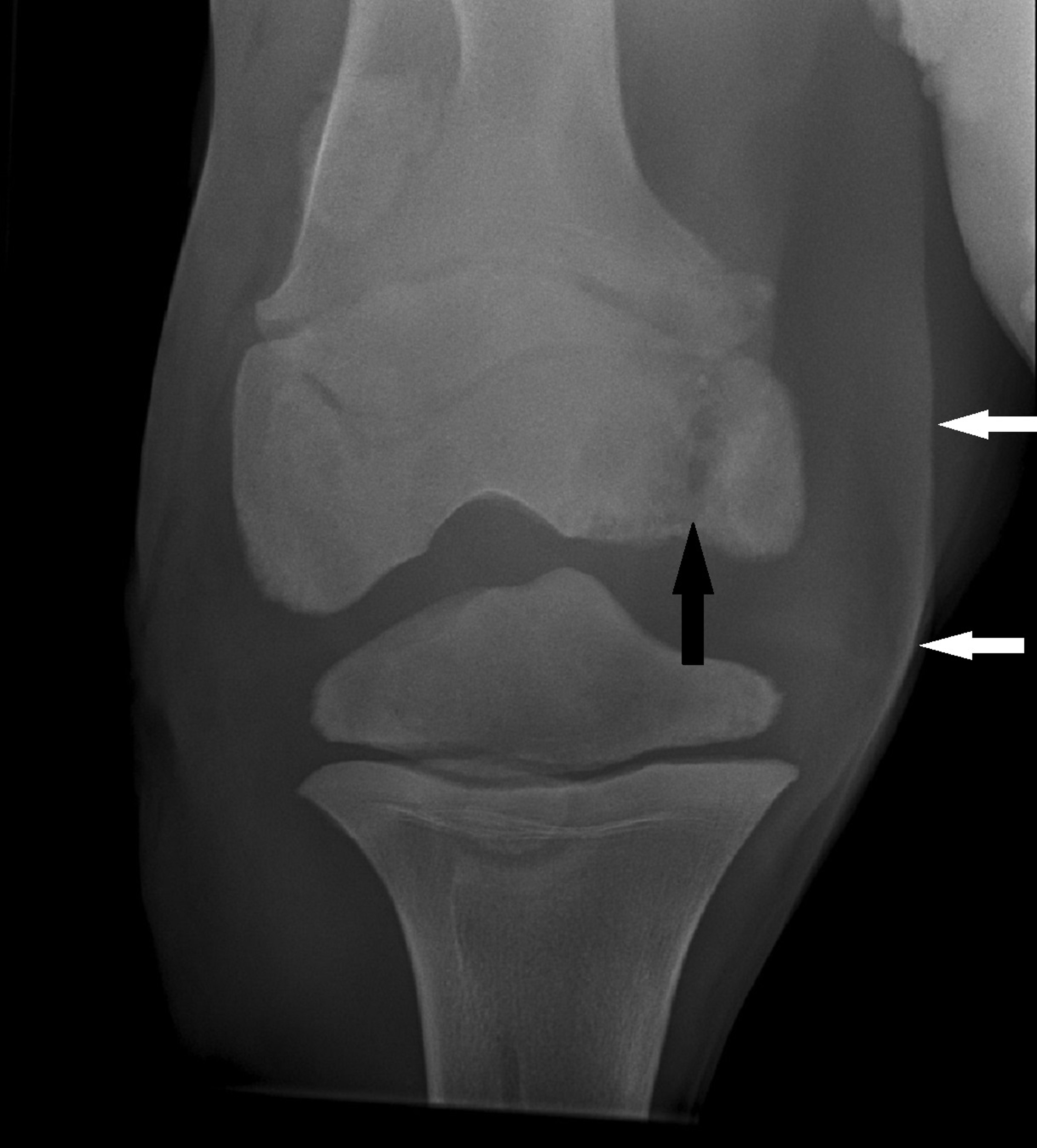 Artritis séptica, rodilla, potro